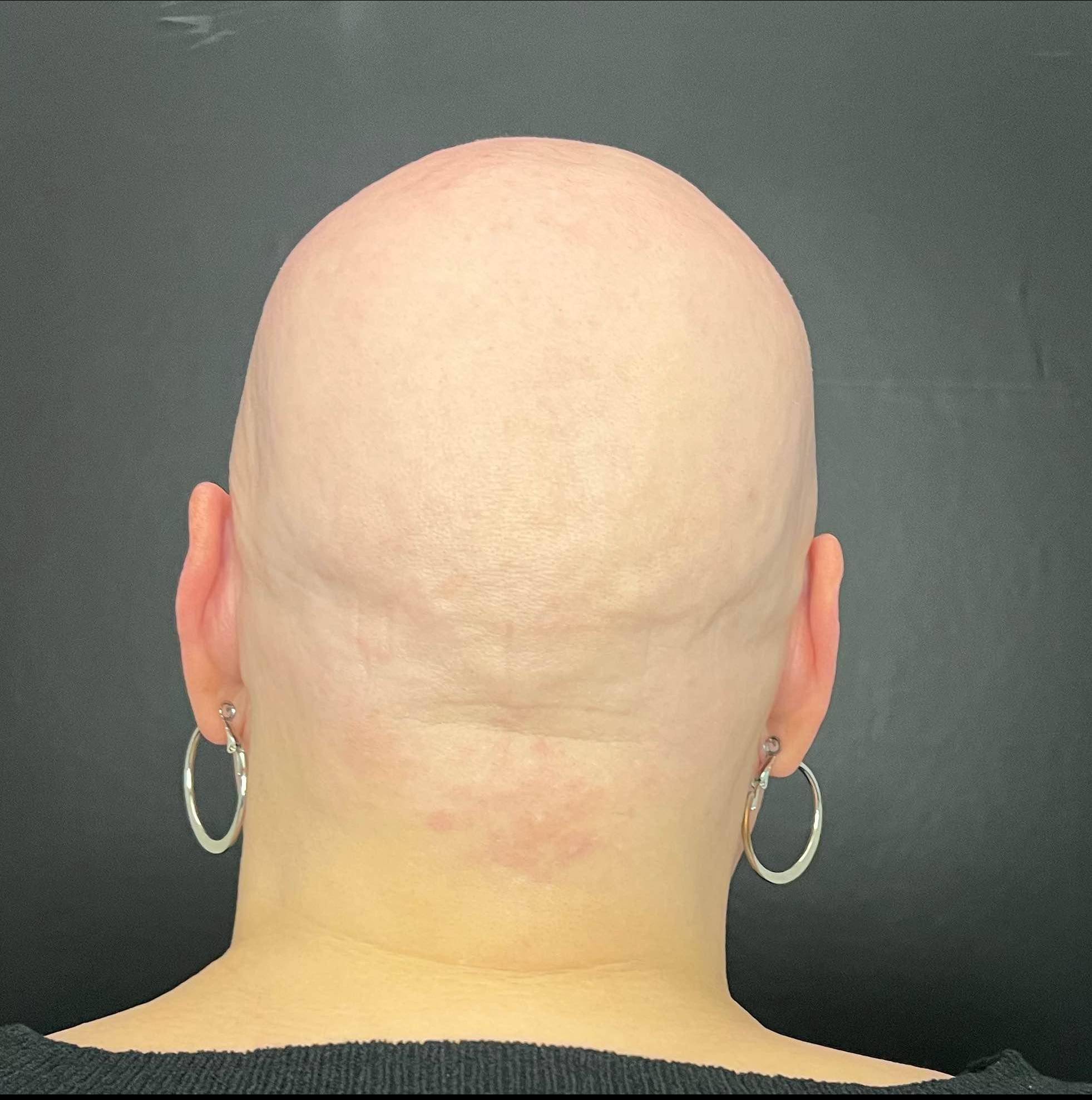 Hair Loss Before and After Case- 20 Before