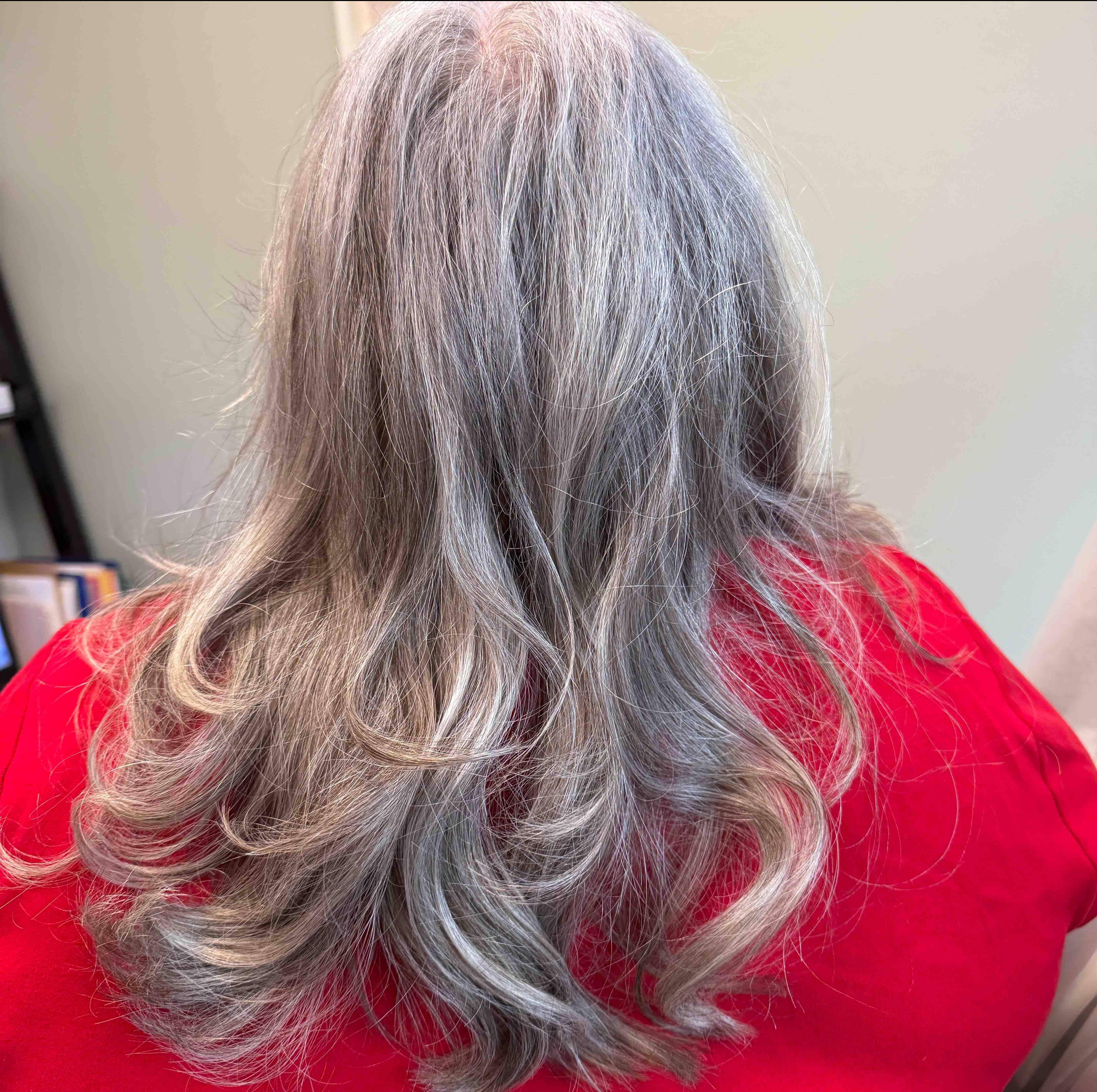 Hair Loss Before and After Case- 20 After