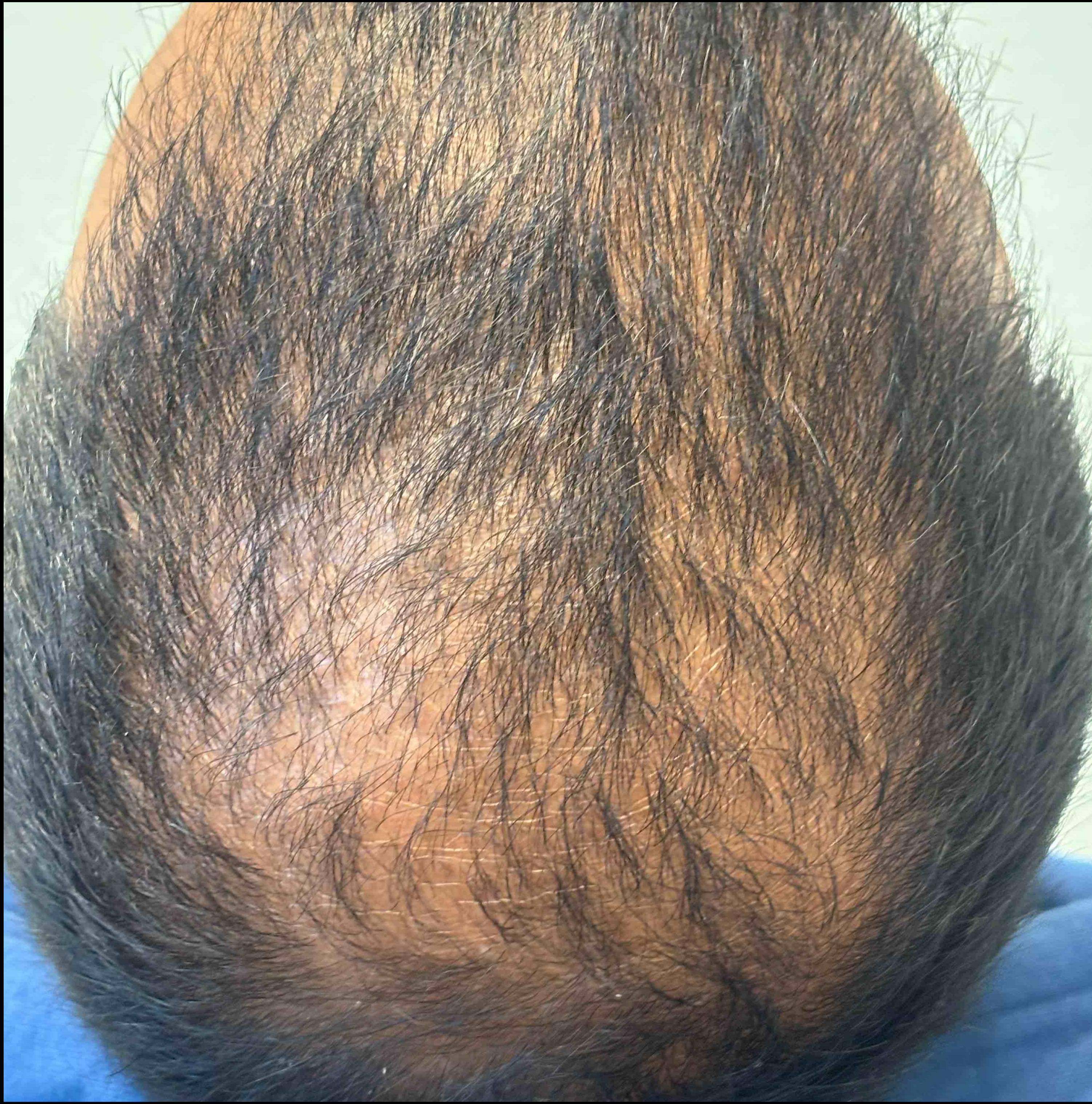 Hair Loss Before and After Case- 21 Before