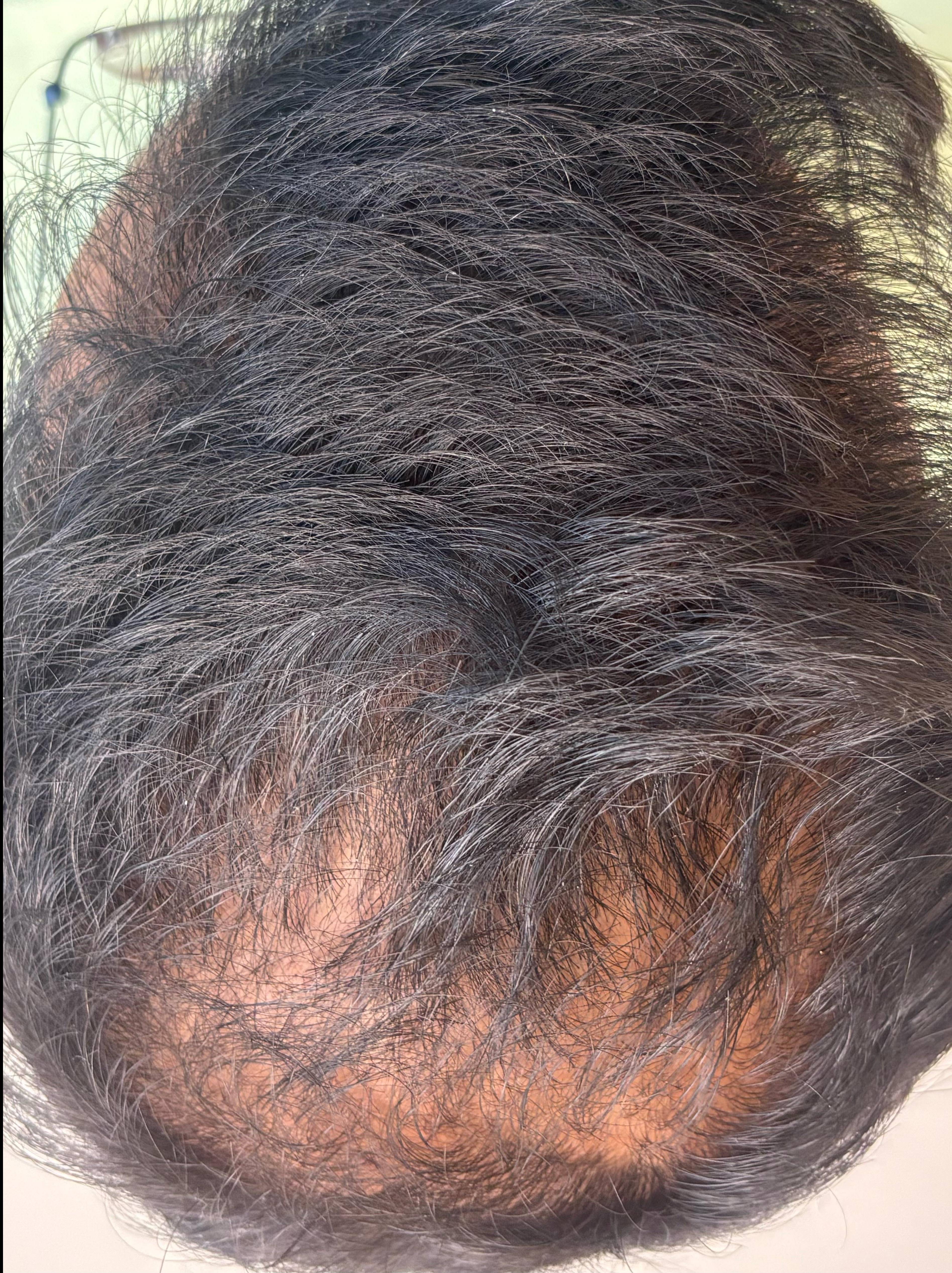 Hair Loss Before and After Case- 21 After