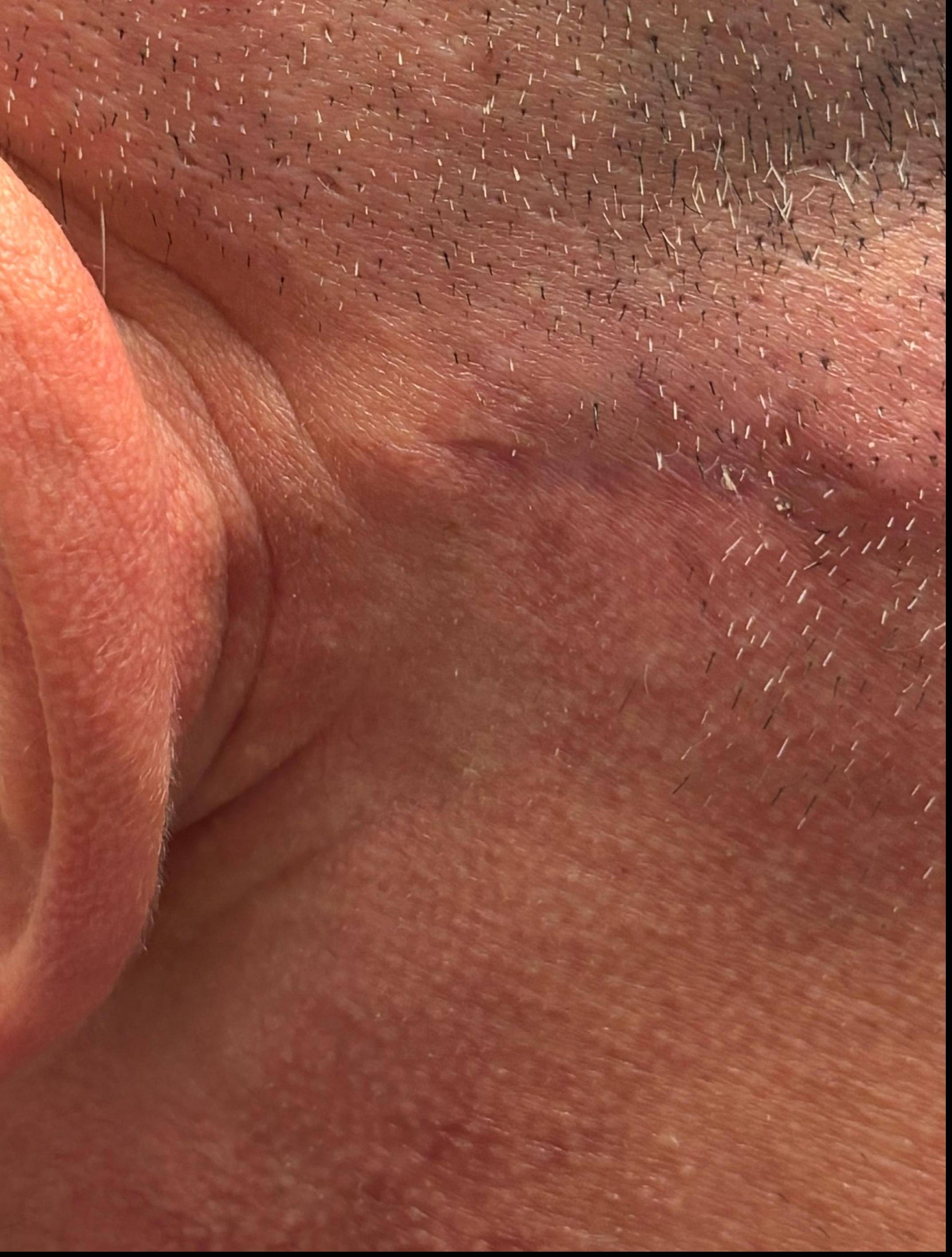 Cyst Removal Before and After Case- 56 After