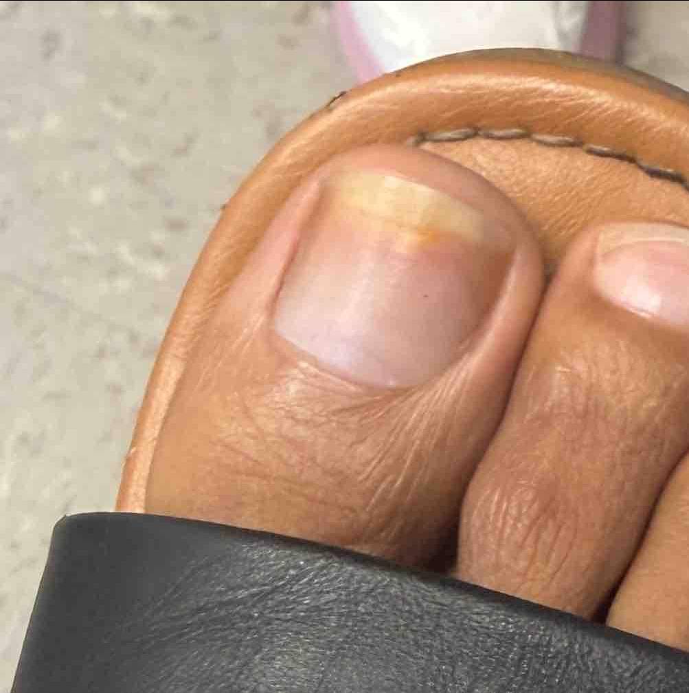 Fungus Before and After Case- 6 After