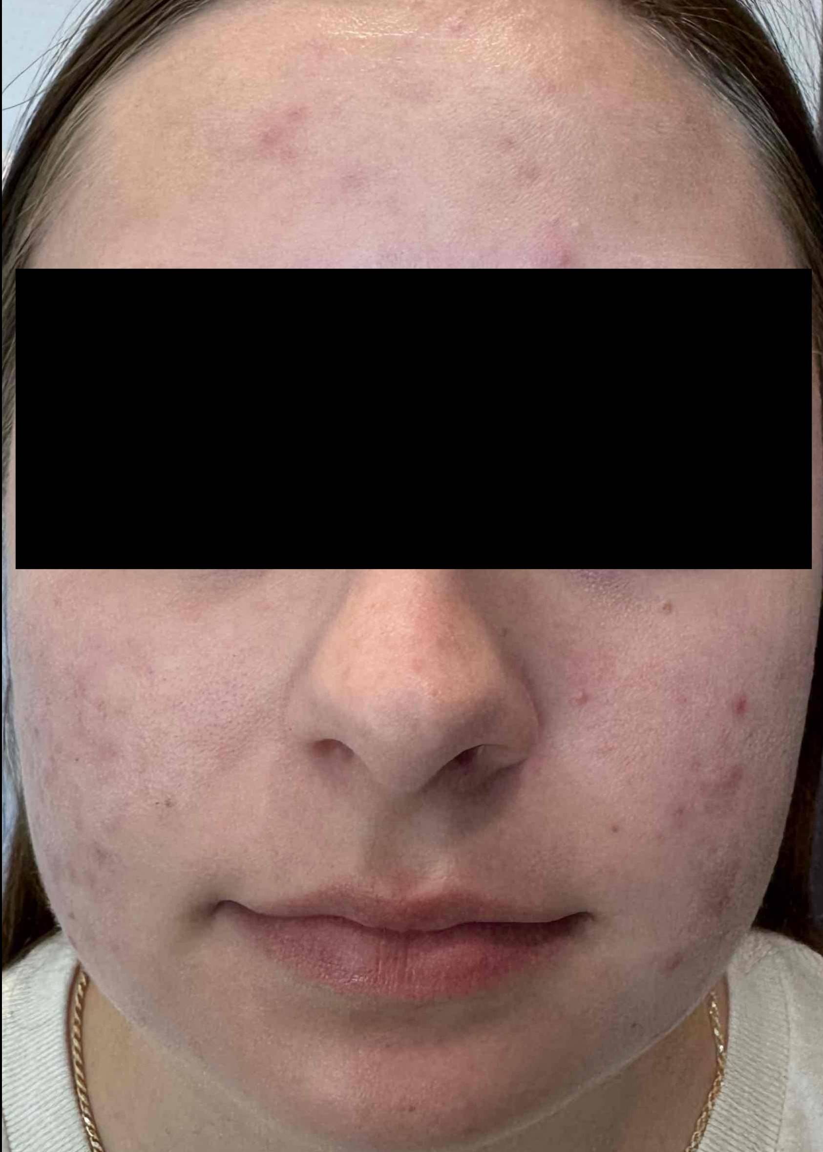 Acne Before and After Case- 33 Before