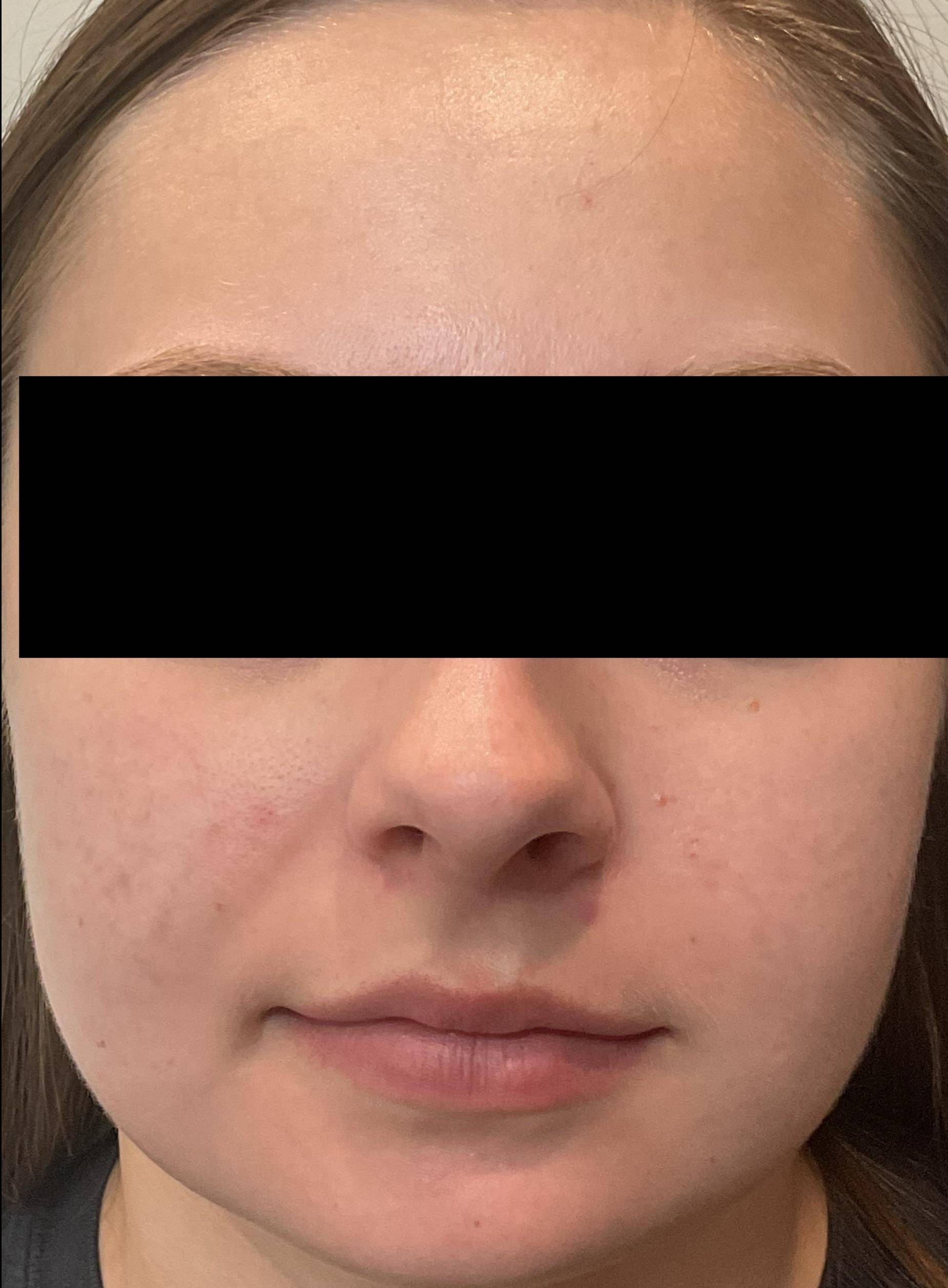 Acne Before and After Case- 33 After