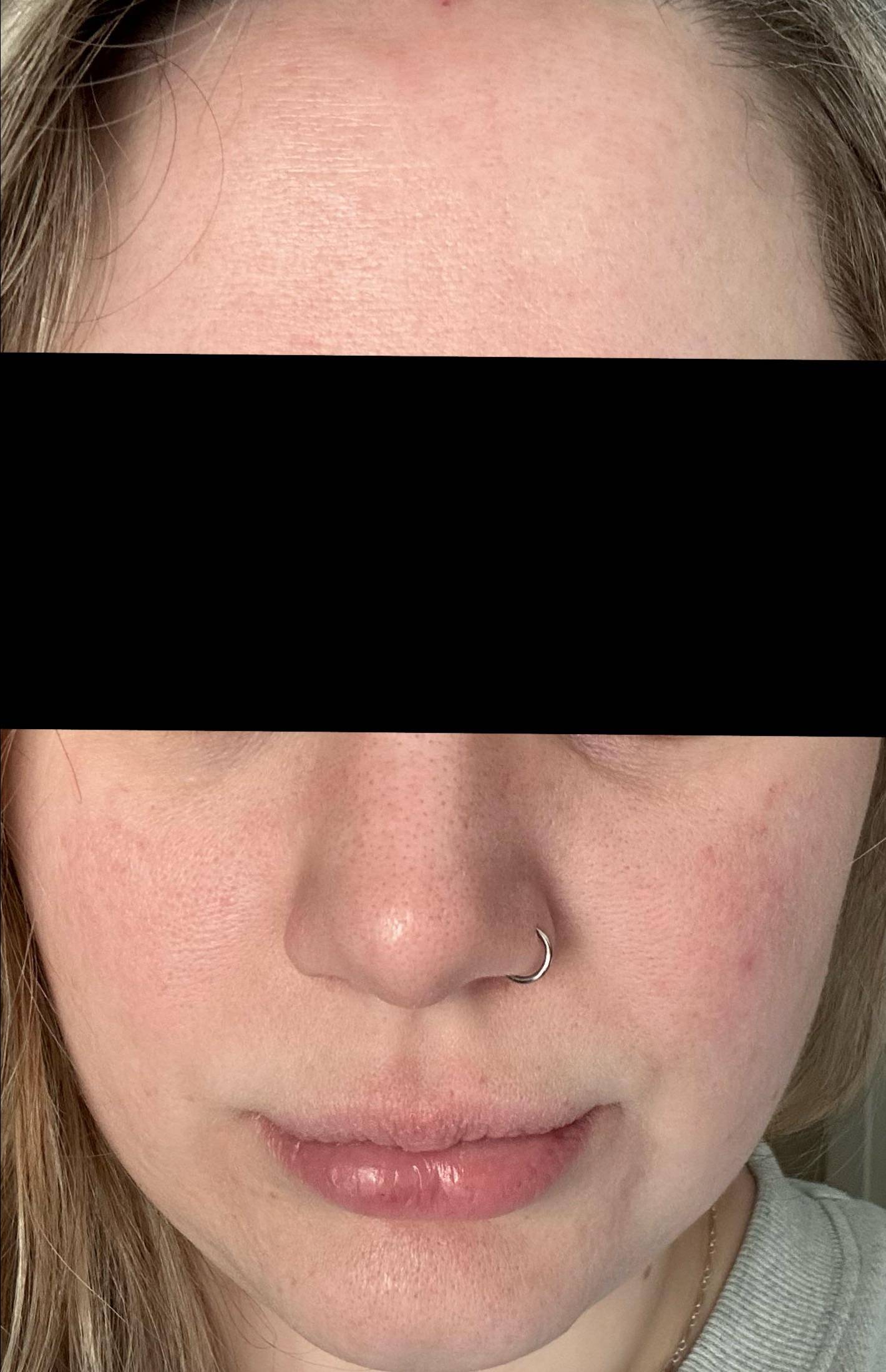 Acne Before and After Case- 34 After