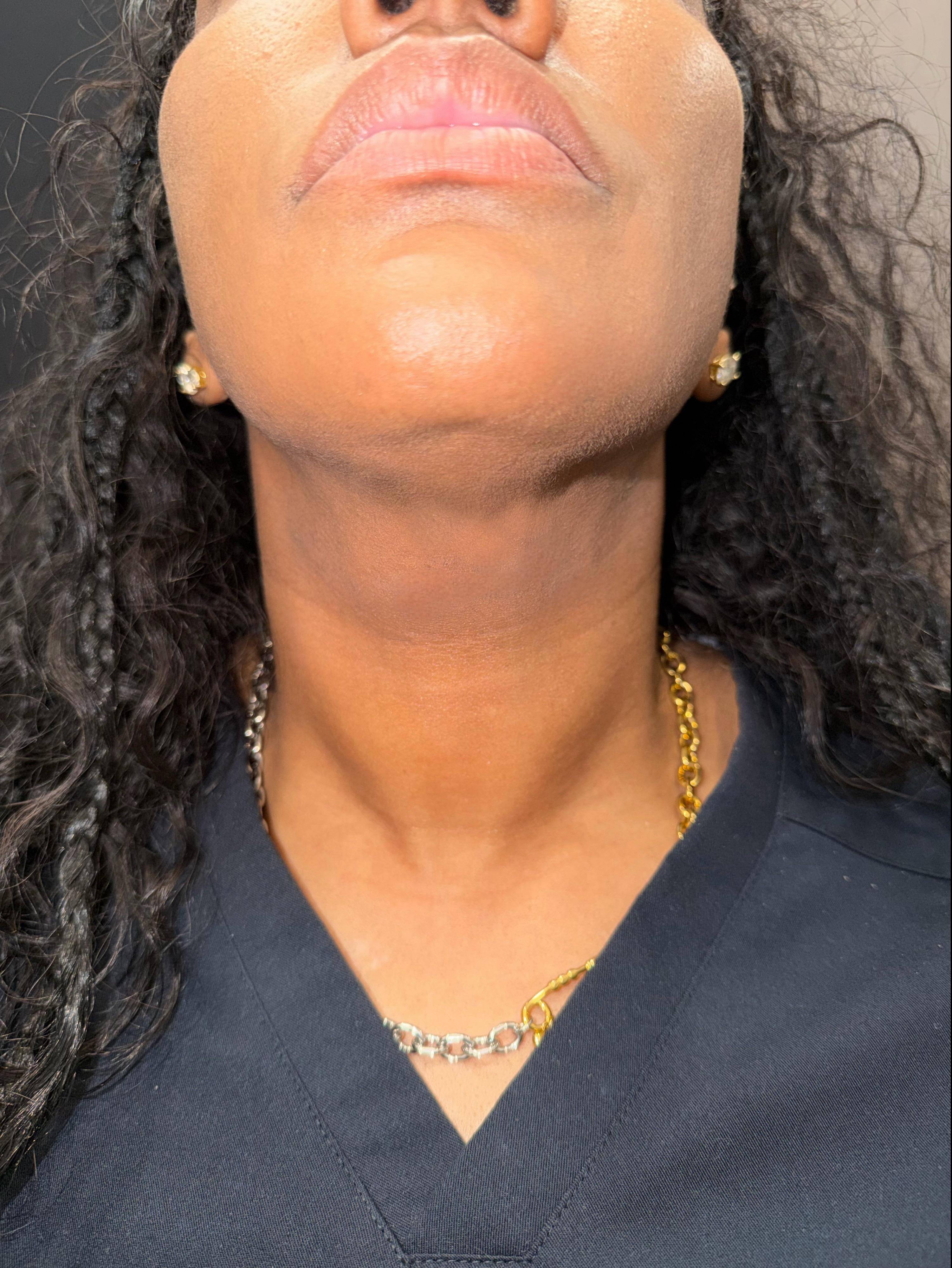 Radiesse Before and After Case- 20 After