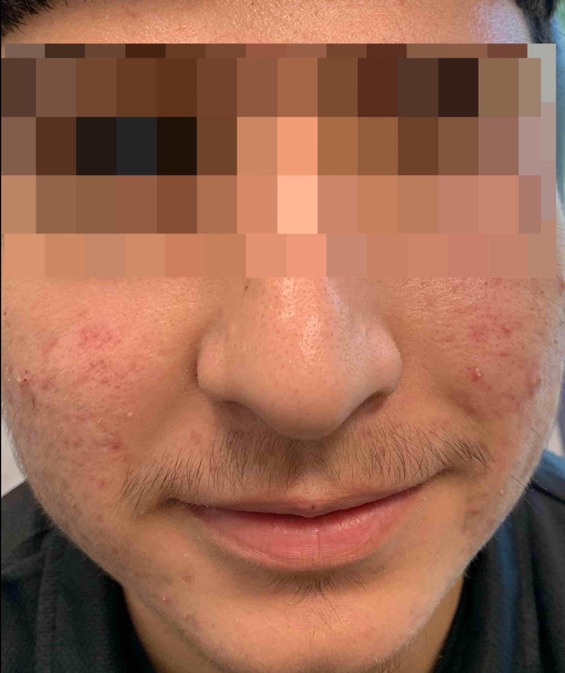 Acne Before and After Case 35 Before