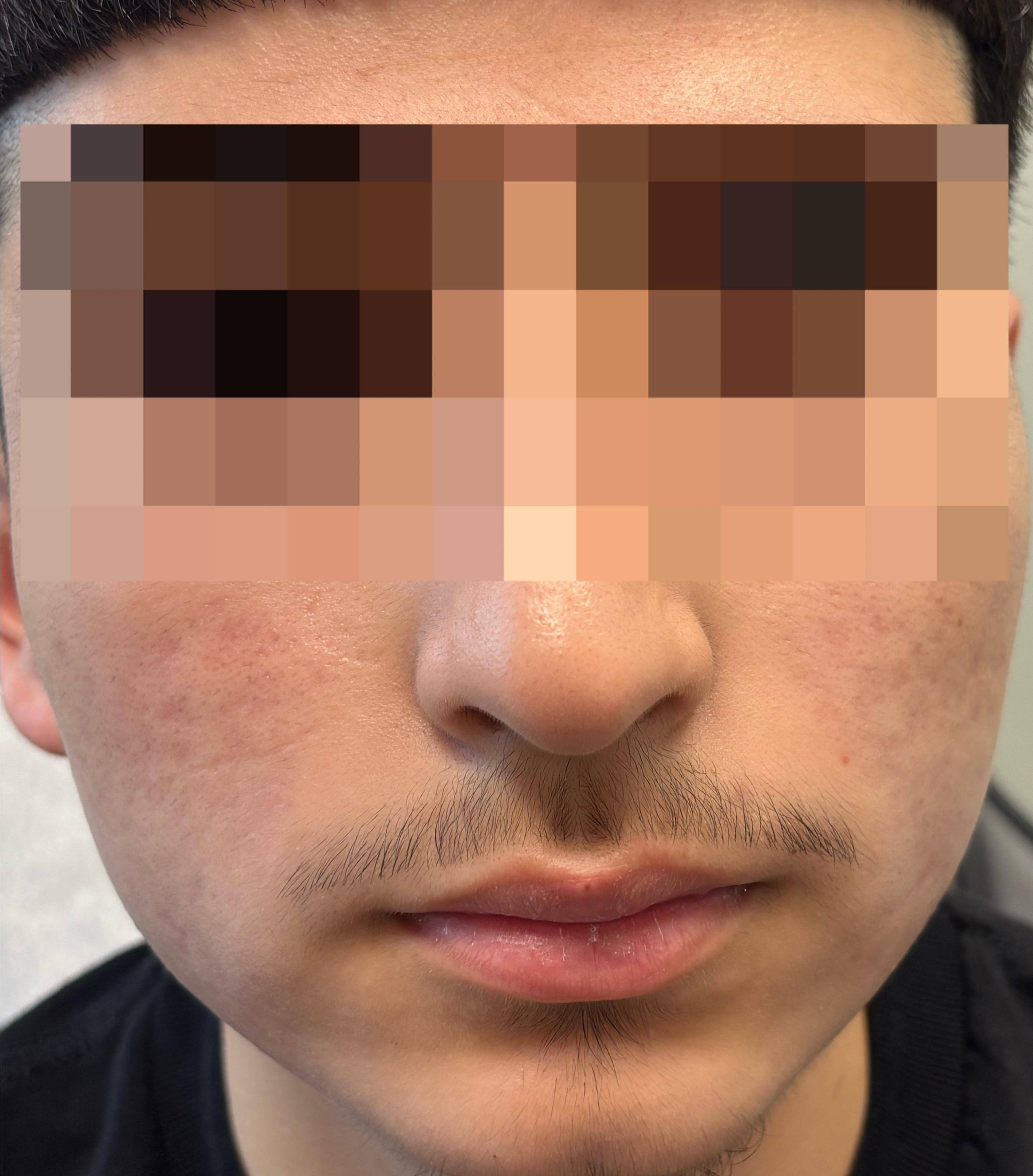 Acne Before and After Case 35 After