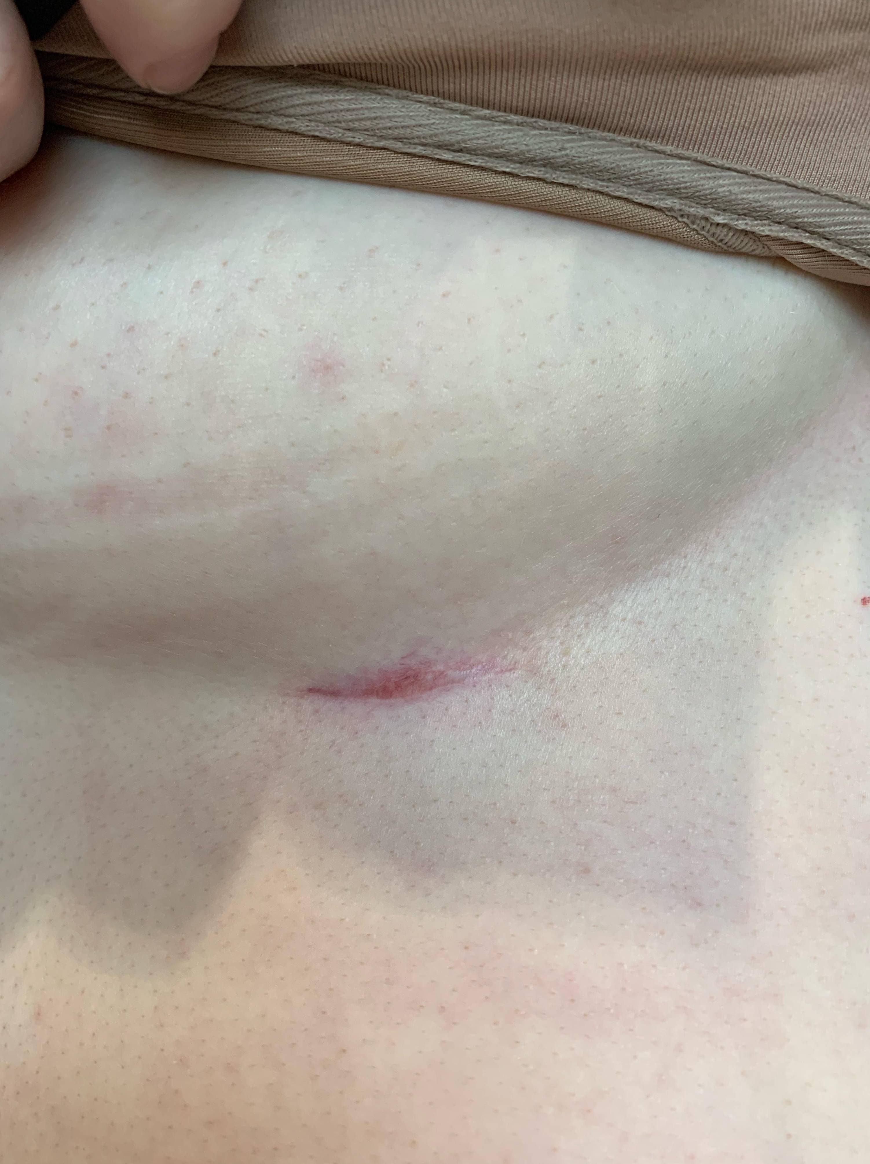 Cyst Removal Before and After Case- 58 After