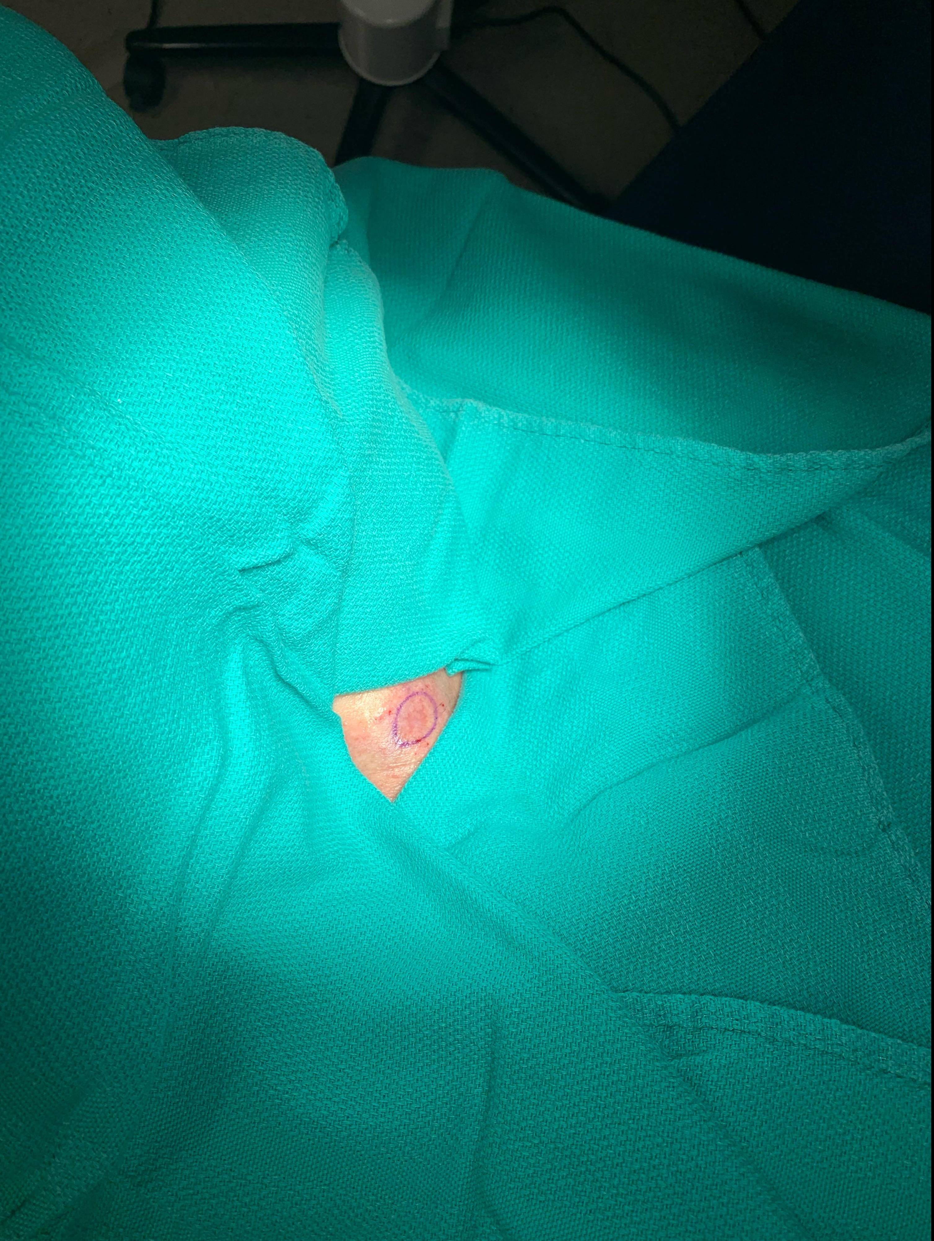 Cyst Removal Before and After Case- 59 After