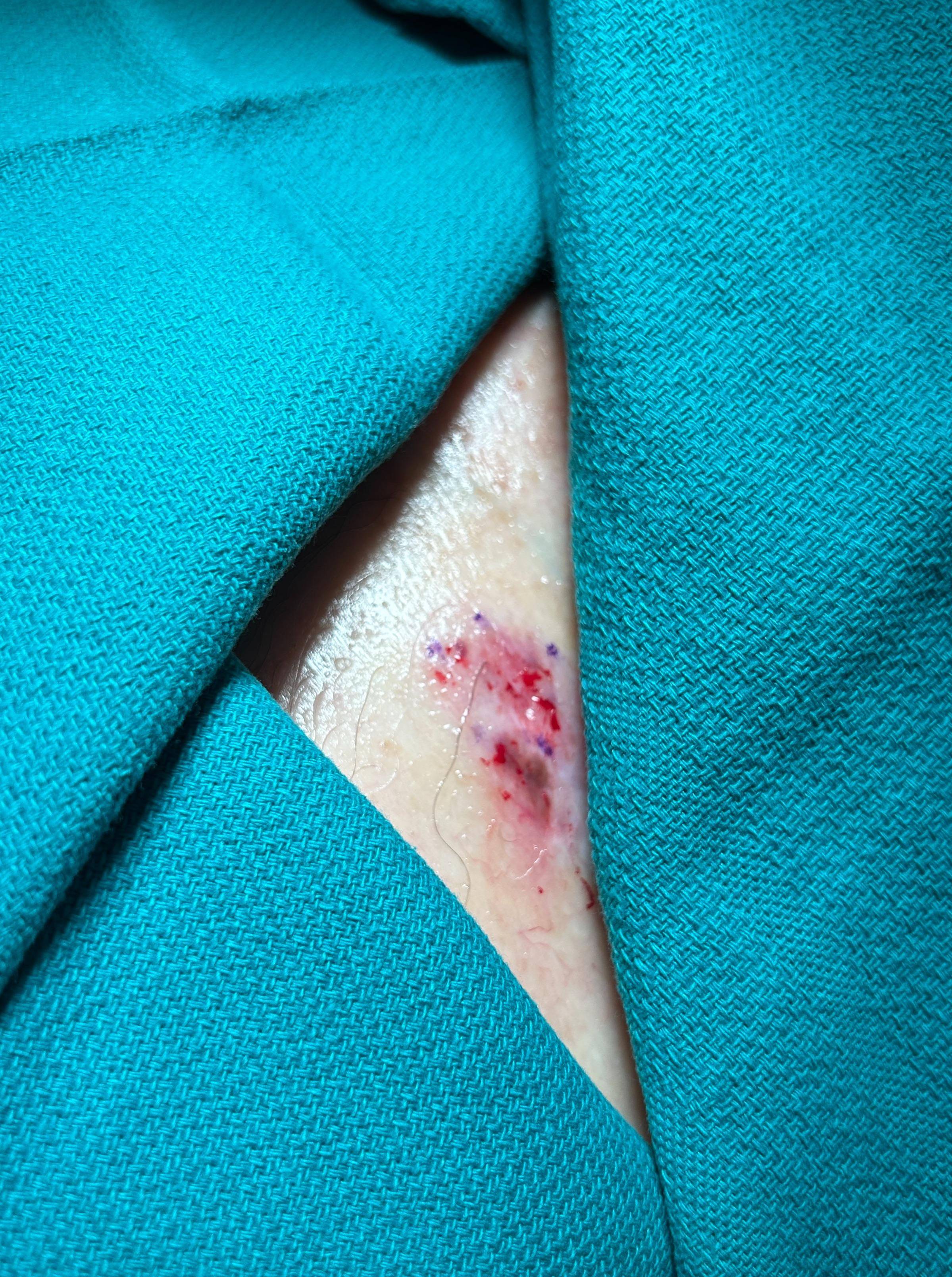 Cyst Removal Before and After Case- 60 Before