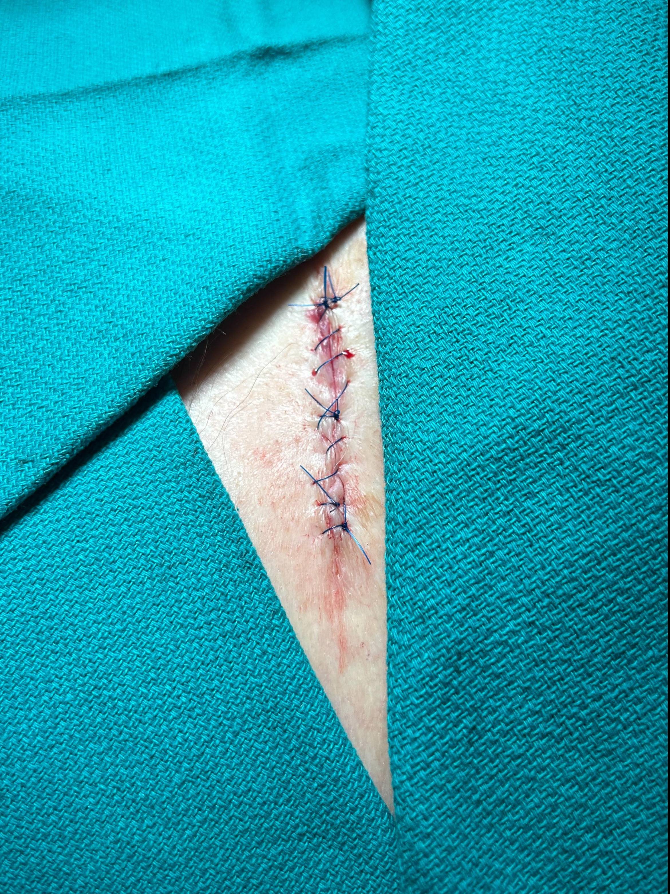 Cyst Removal Before and After Case- 60 After