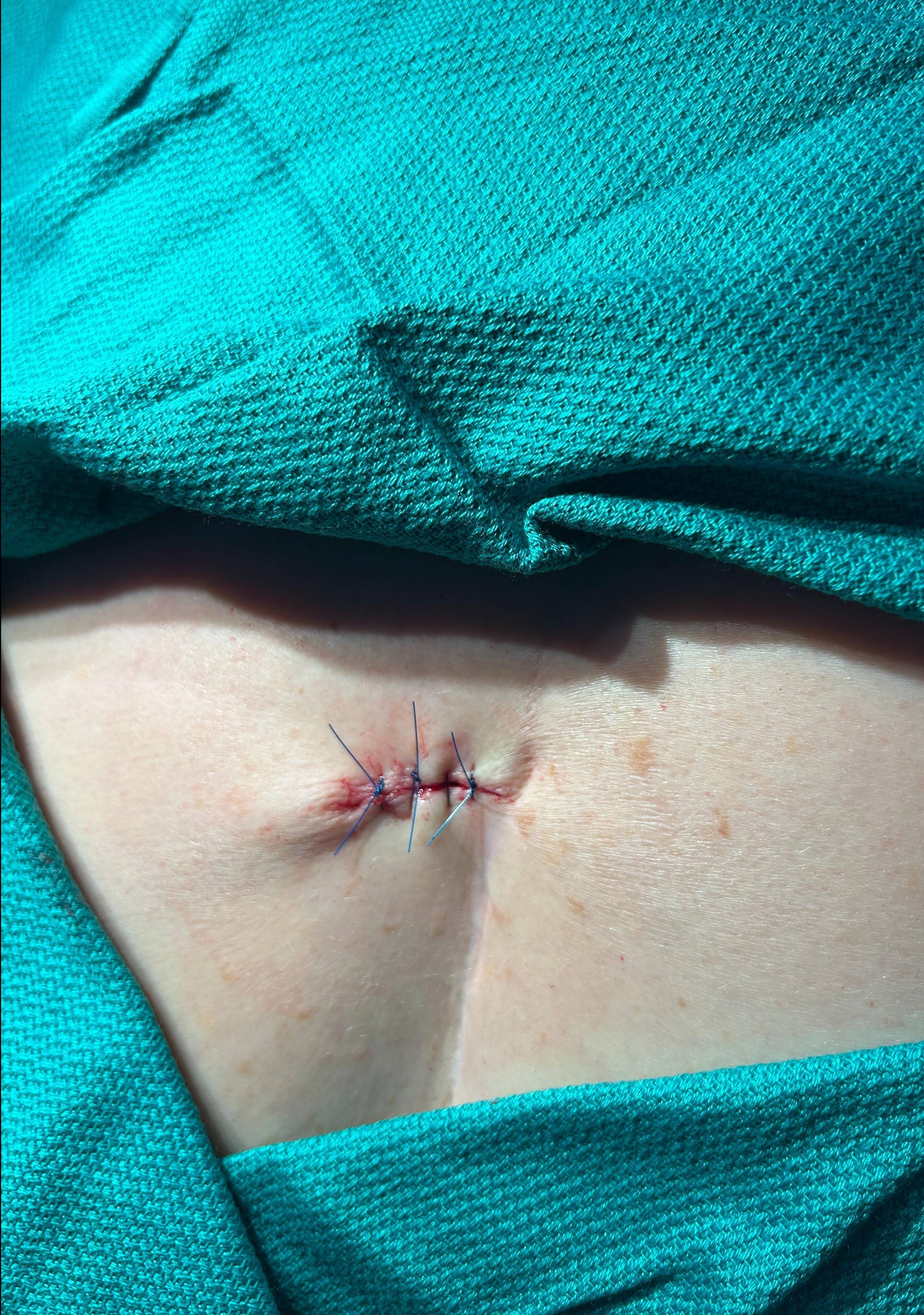 Cyst Removal Before and After Case- 61 After