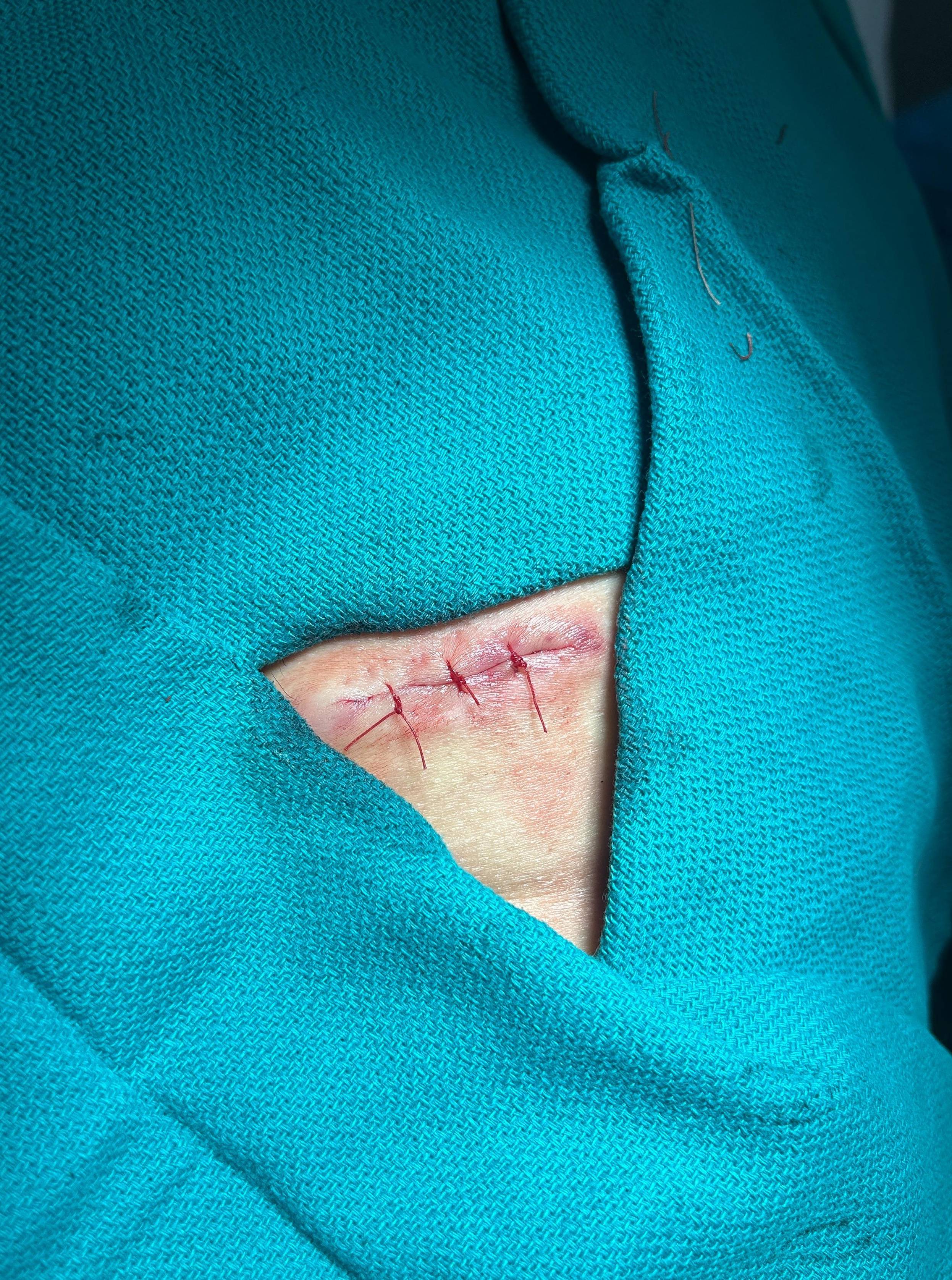 Cyst Removal Before and After Case- 63 After
