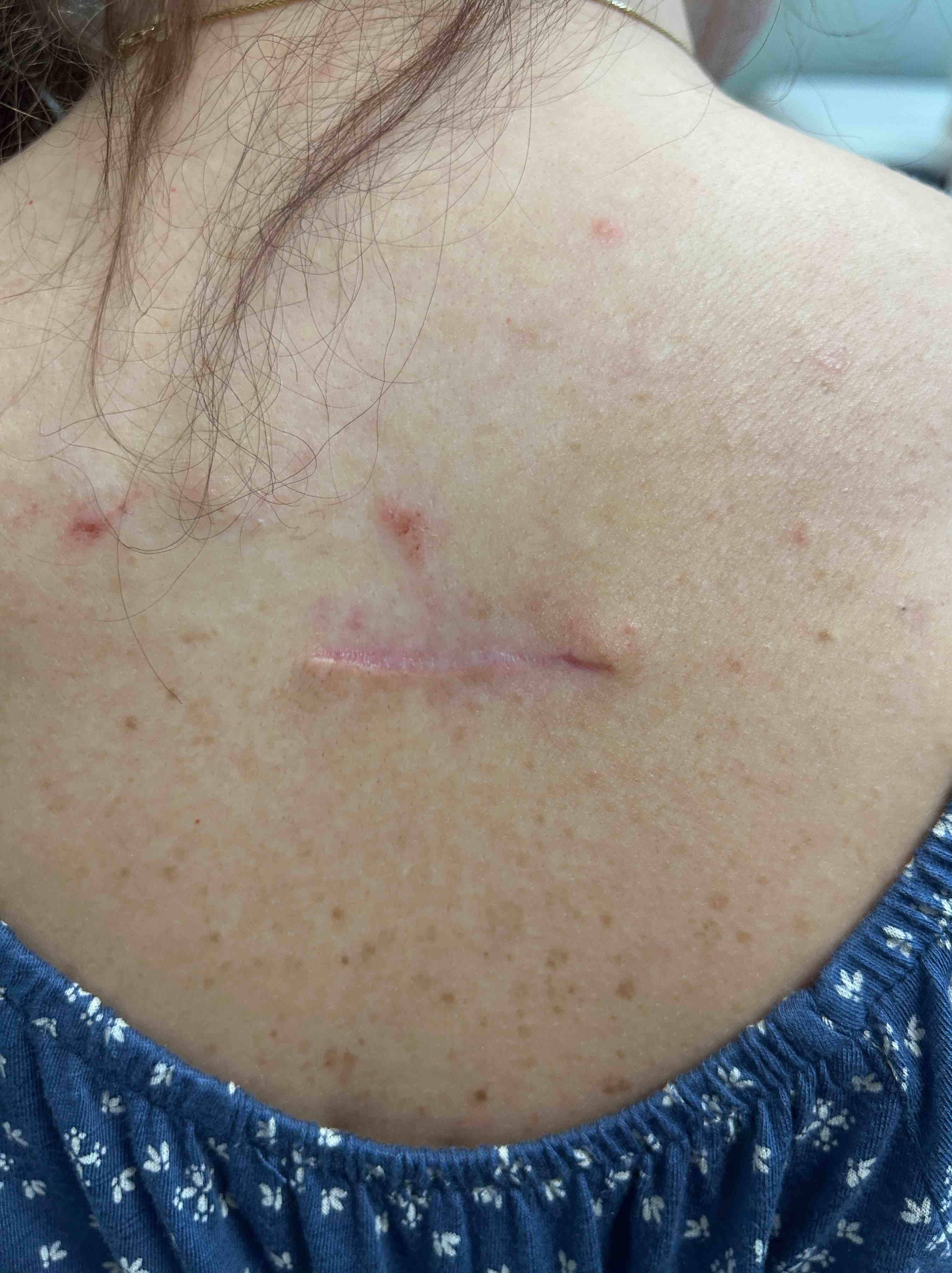 Cyst Removal Before and After Case- 64 After