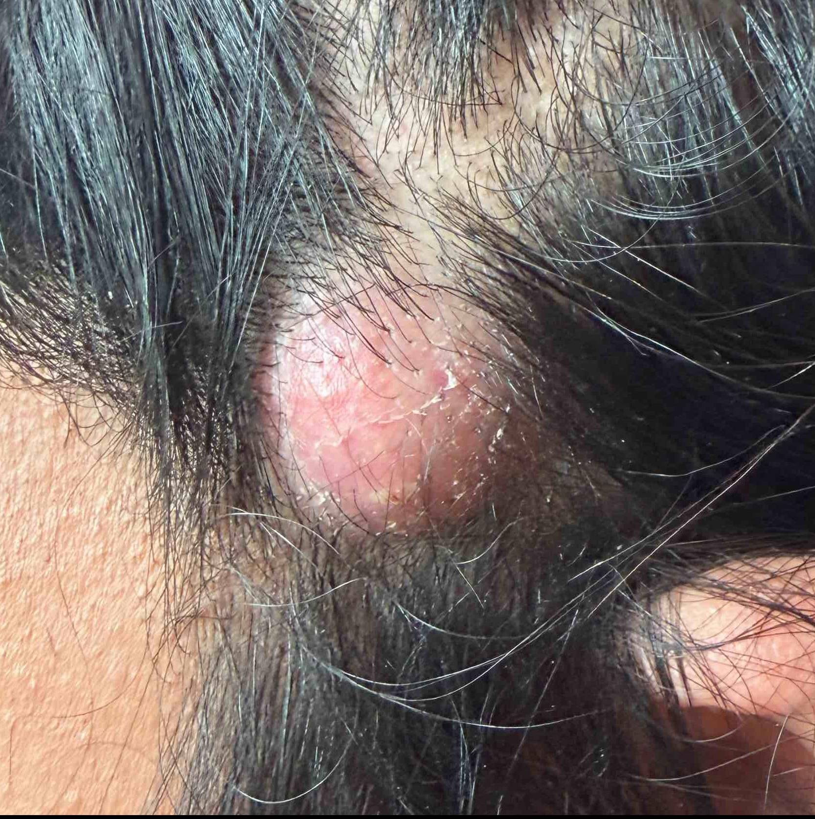 Cyst Removal Before and After Case- 65 Before