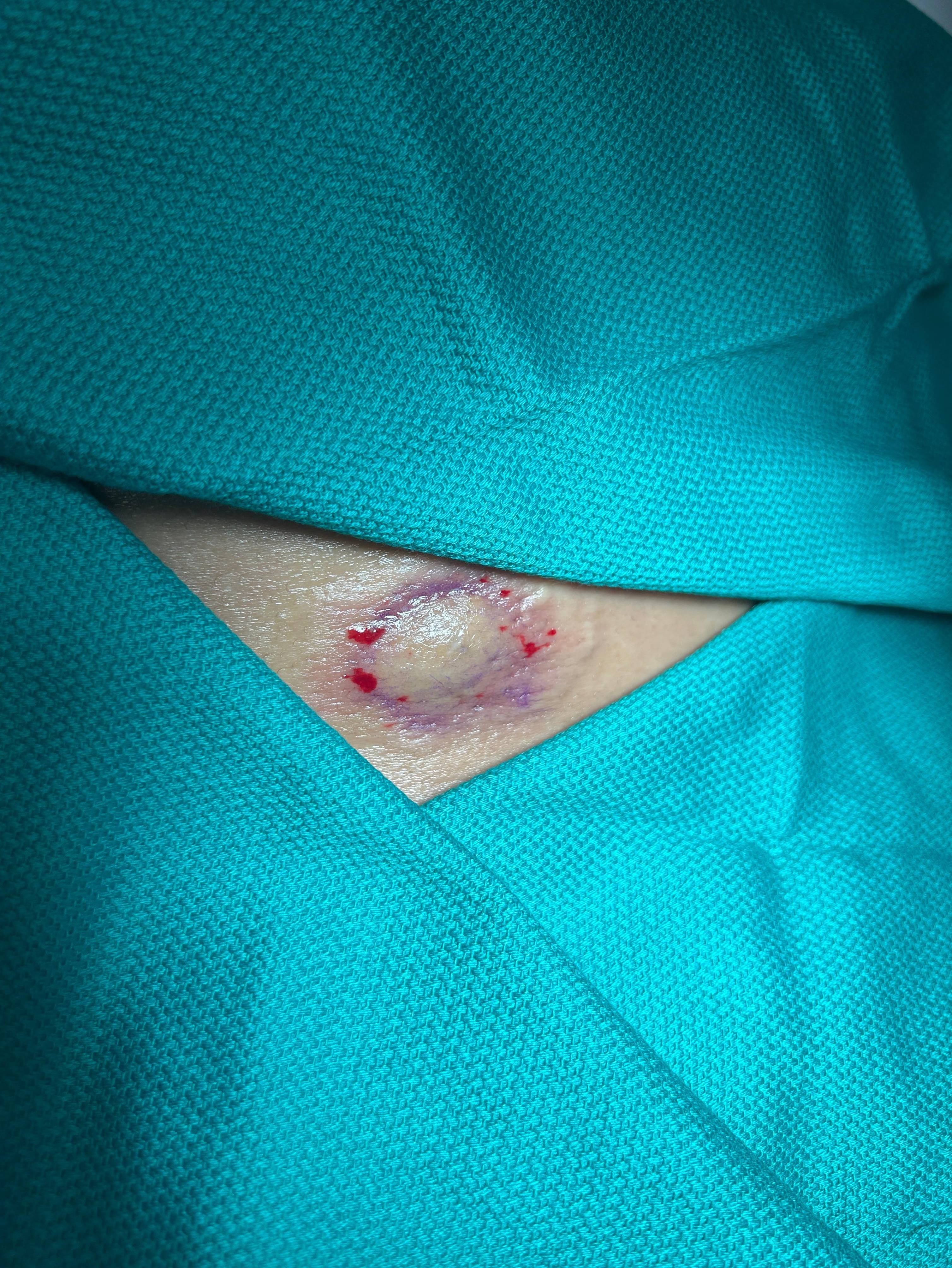 Cyst Removal Before and After Case- 66 Before Cyst Removal Before and After Case- 66 Before