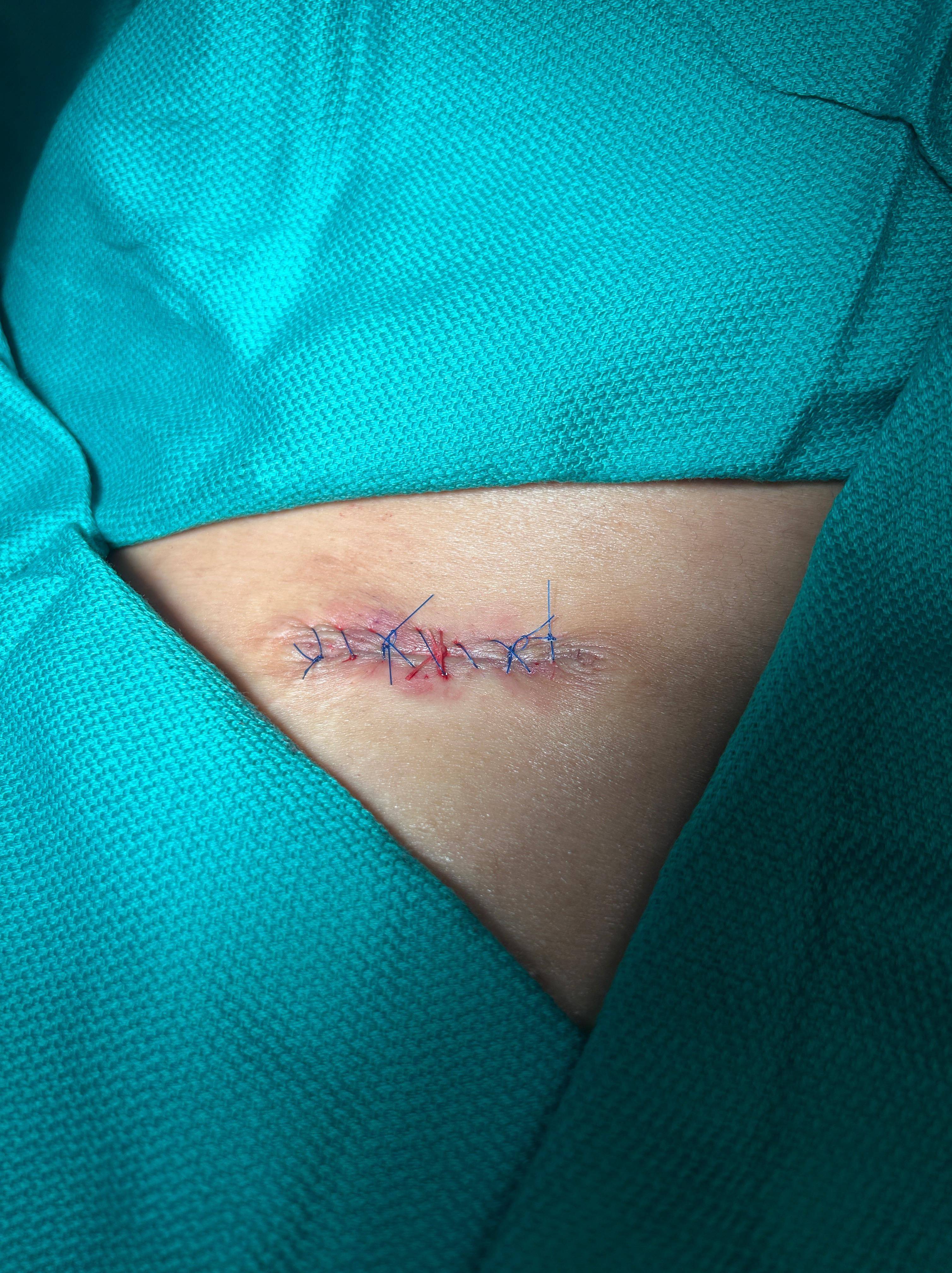 Cyst Removal Before and After Case- 66 After Cyst Removal Before and After Case- 66 After