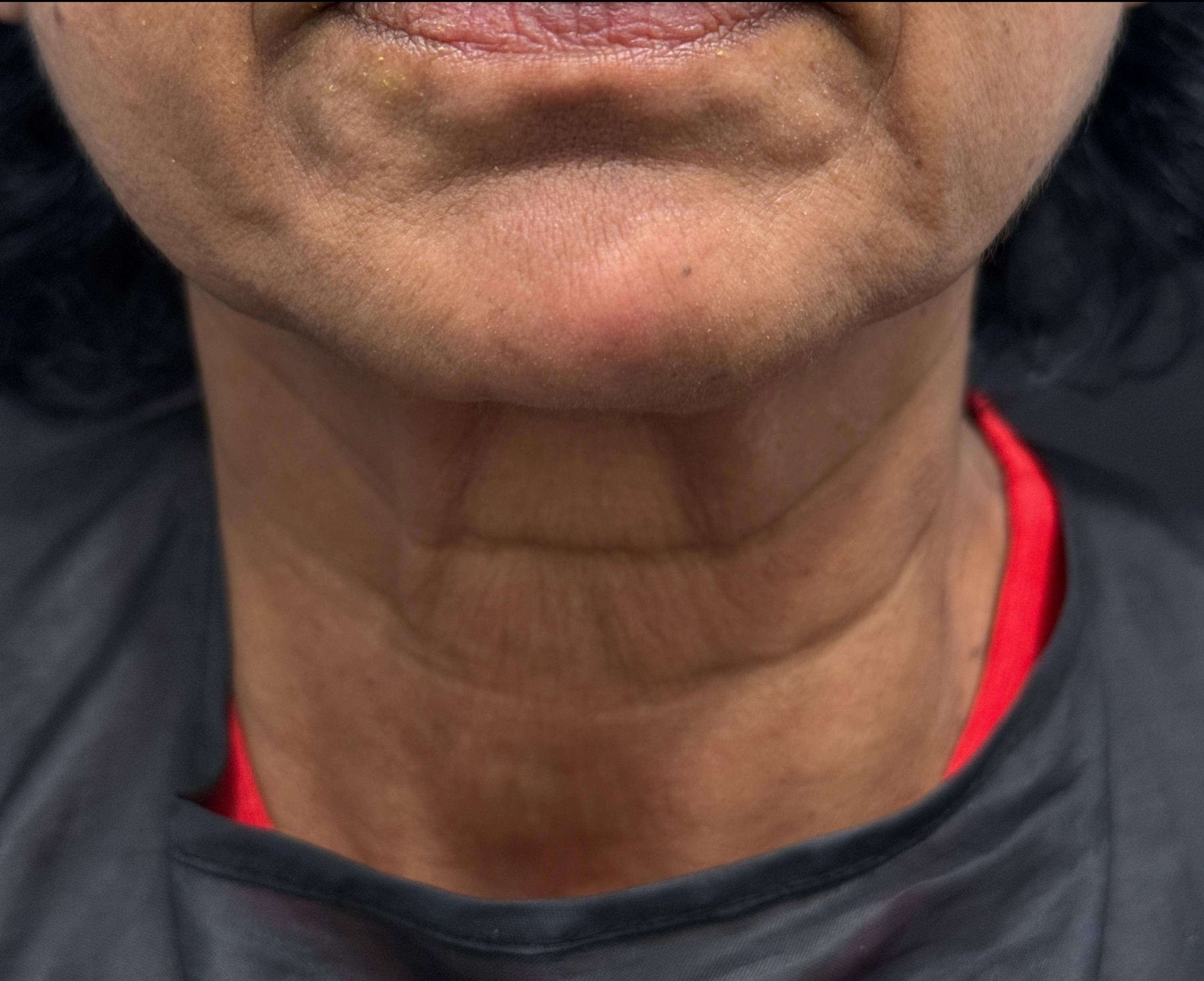 Botox Before and After Case- 24 Before Botox Before and After Case- 24 Before