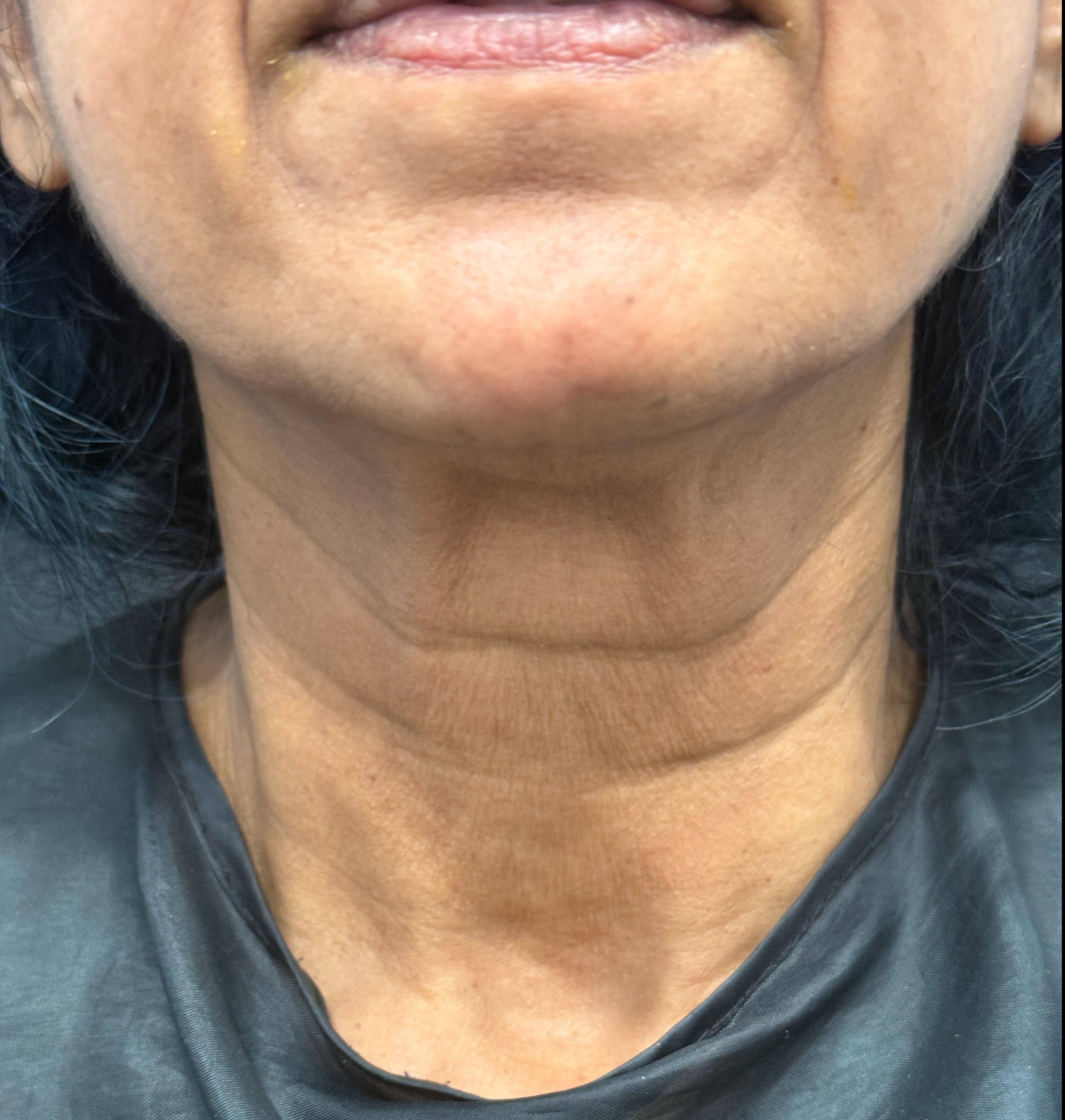 Botox Before and After Case- 24 After Botox Before and After Case- 24 After