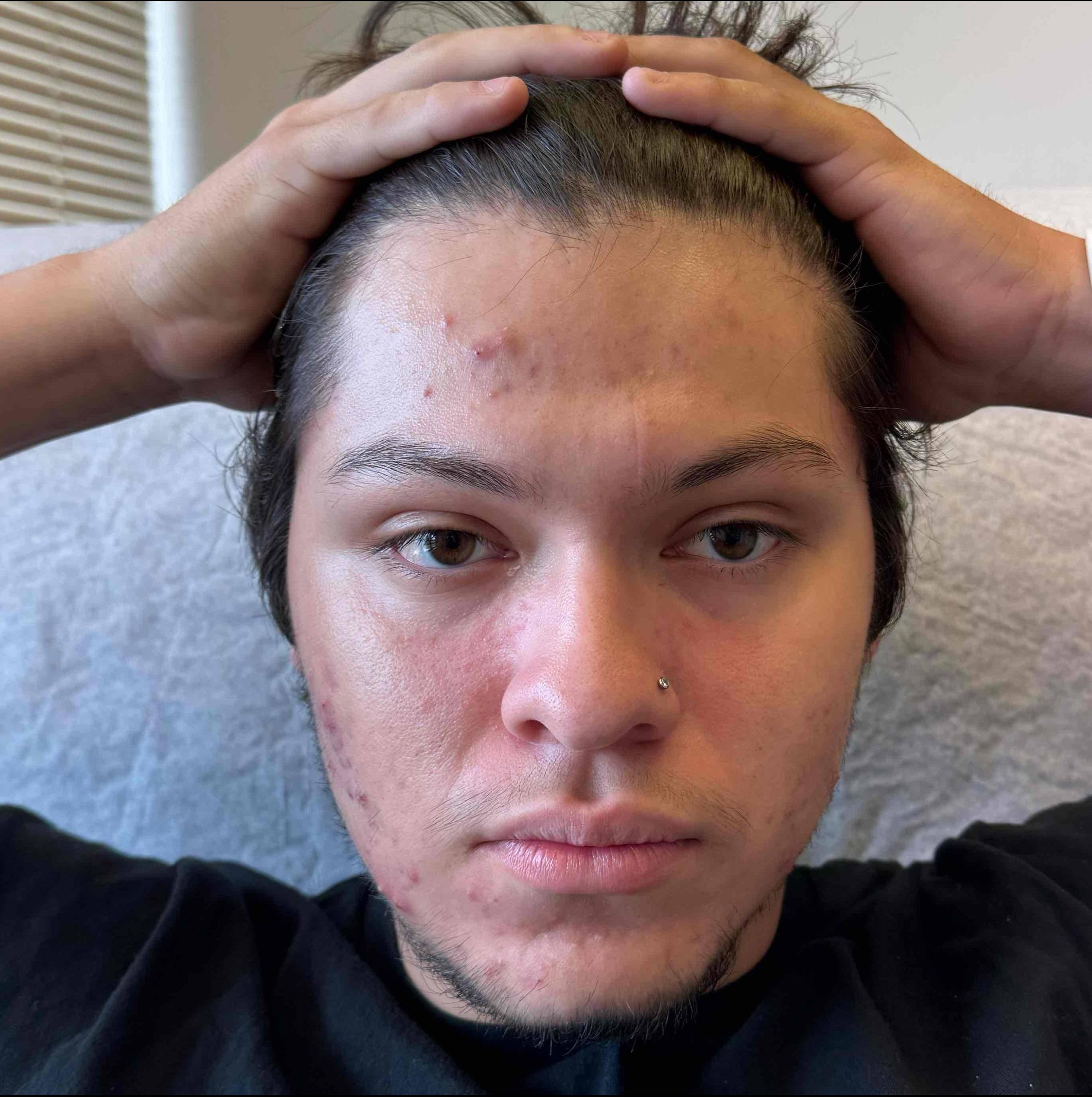 Acne Before and After Case 36 Before Acne Before and After Case 36 Before