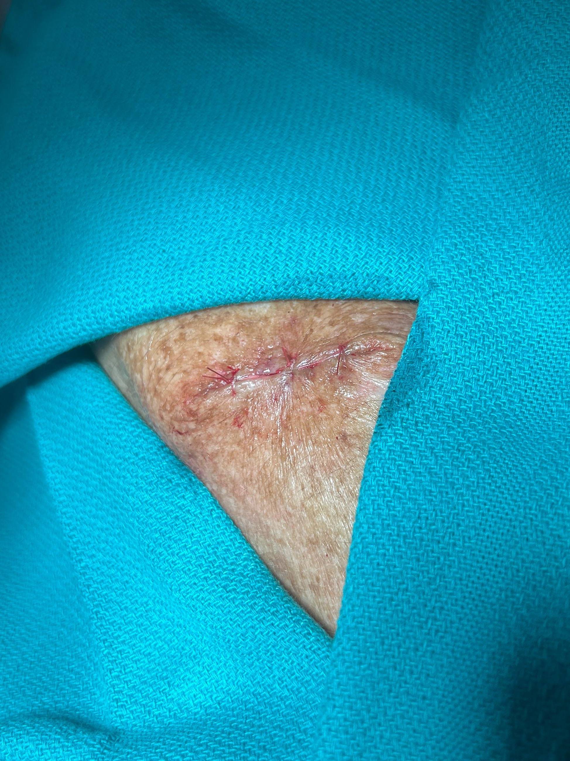 Cyst Removal Before and After Case- 69 Before Cyst Removal Before and After Case- 69 Before