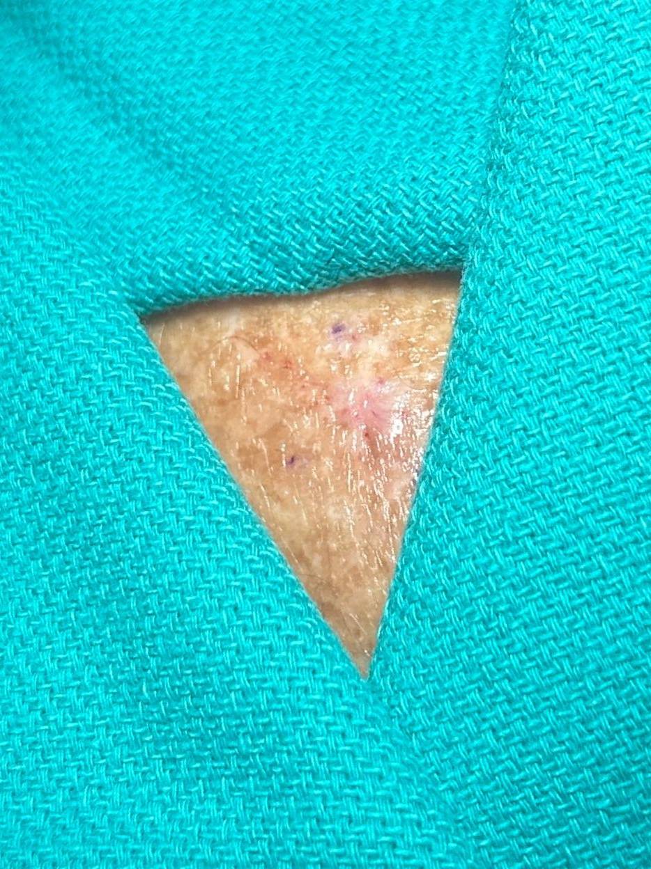 Cyst Removal Before and After Case- 69 After Cyst Removal Before and After Case- 69 After