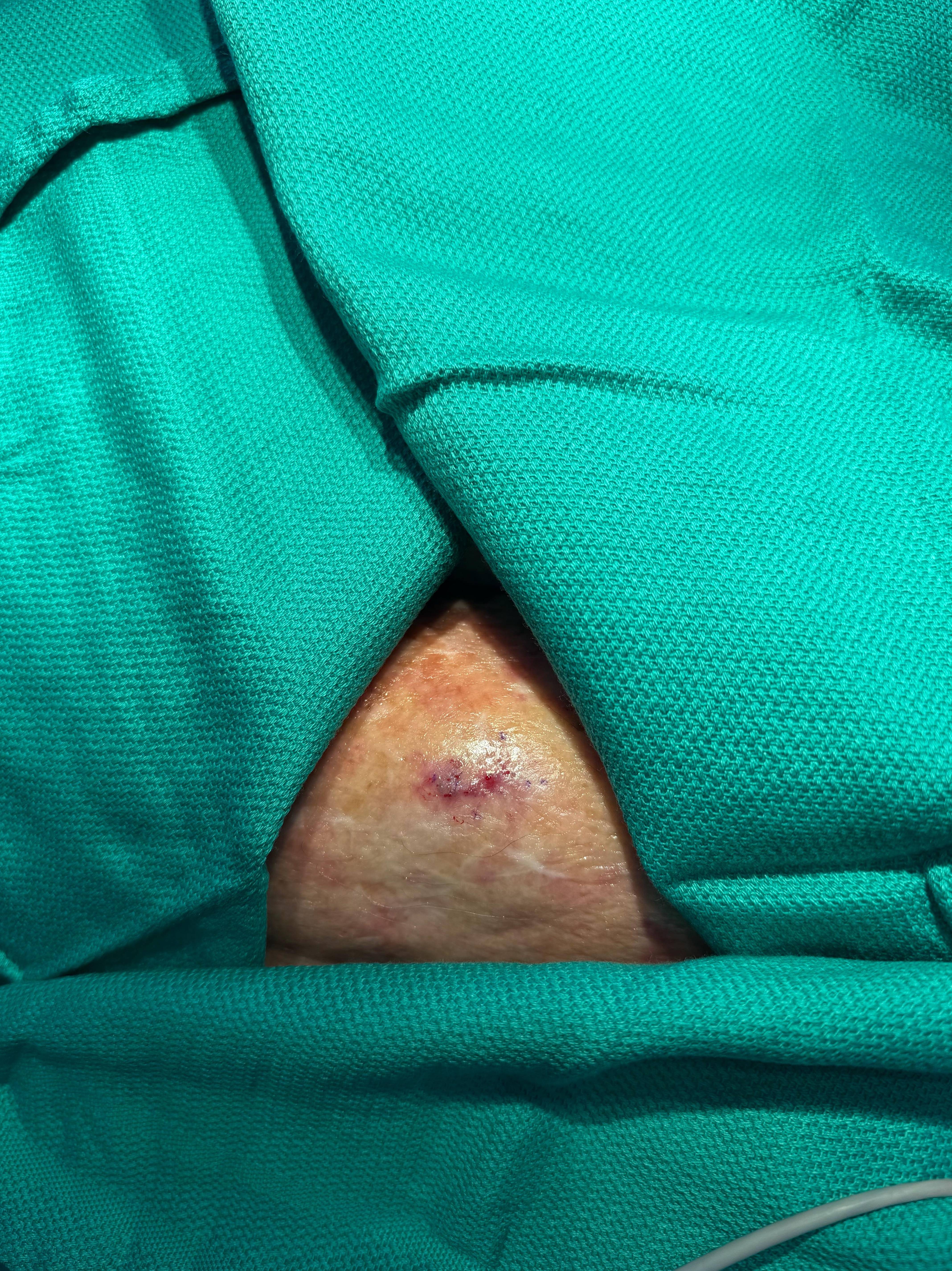 Cyst Removal Before and After Case- 70 Before Cyst Removal Before and After Case- 70 Before