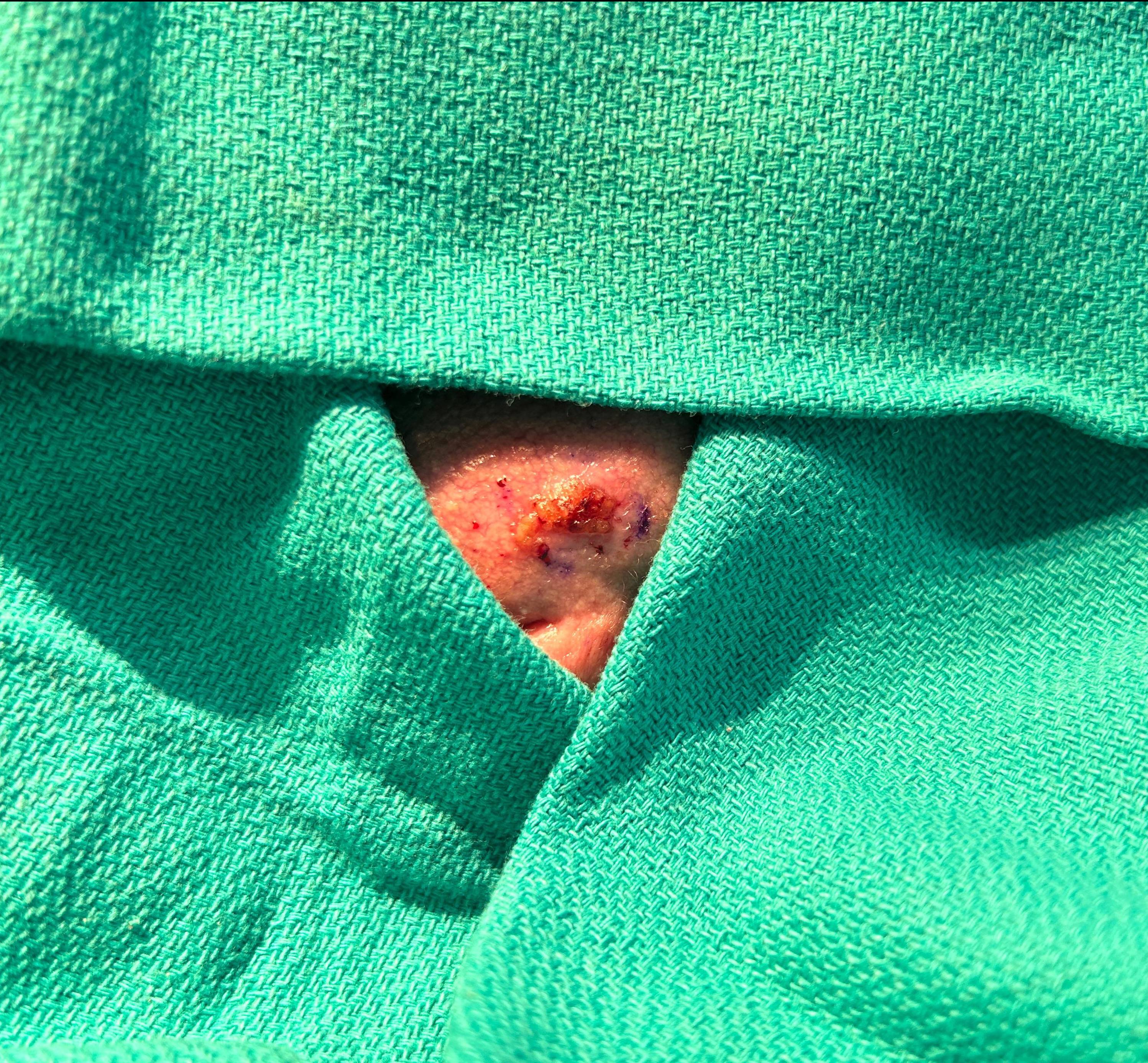 Cyst Removal Before and After Case- 71 Before
