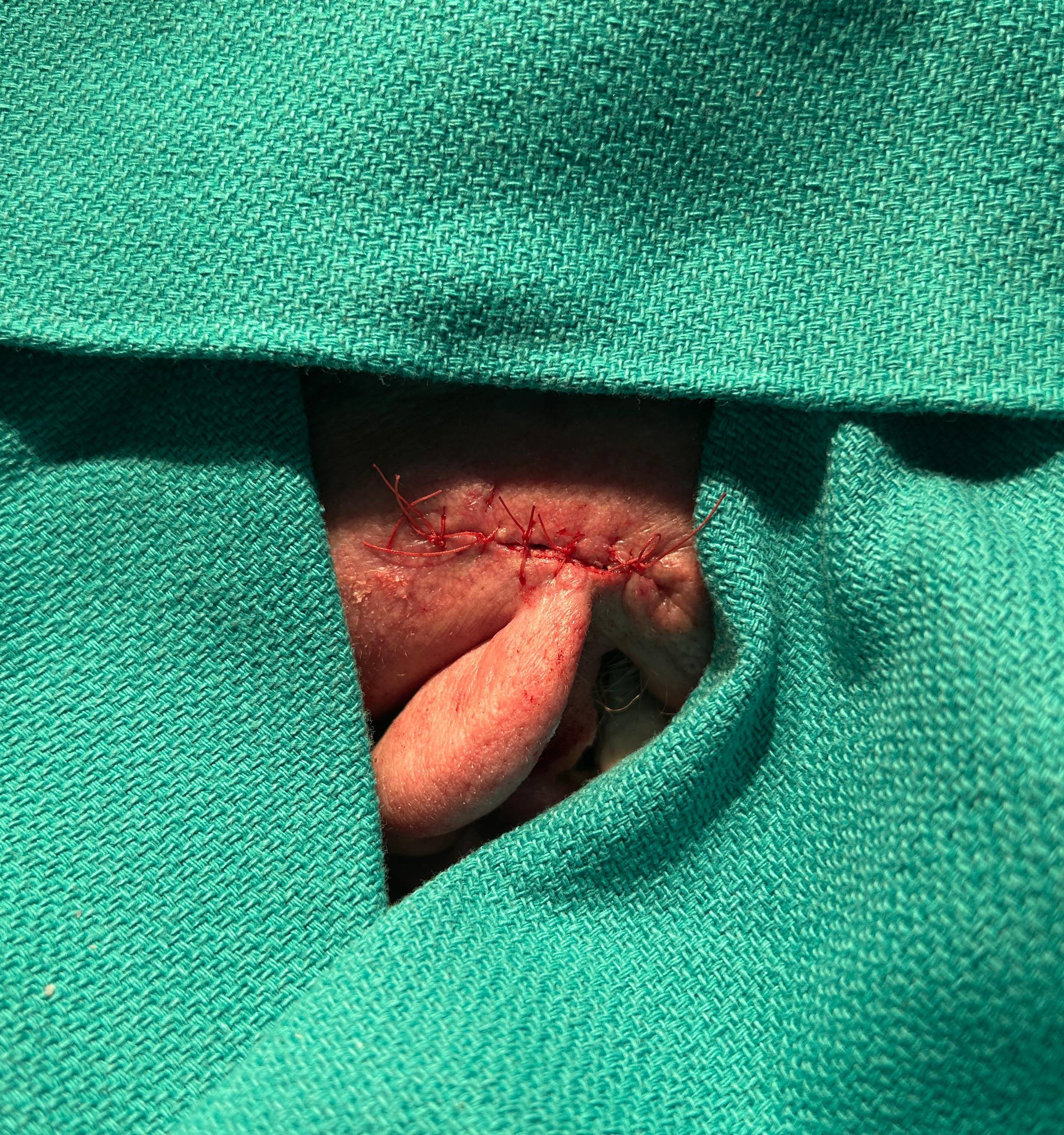 Cyst Removal Before and After Case- 71 After