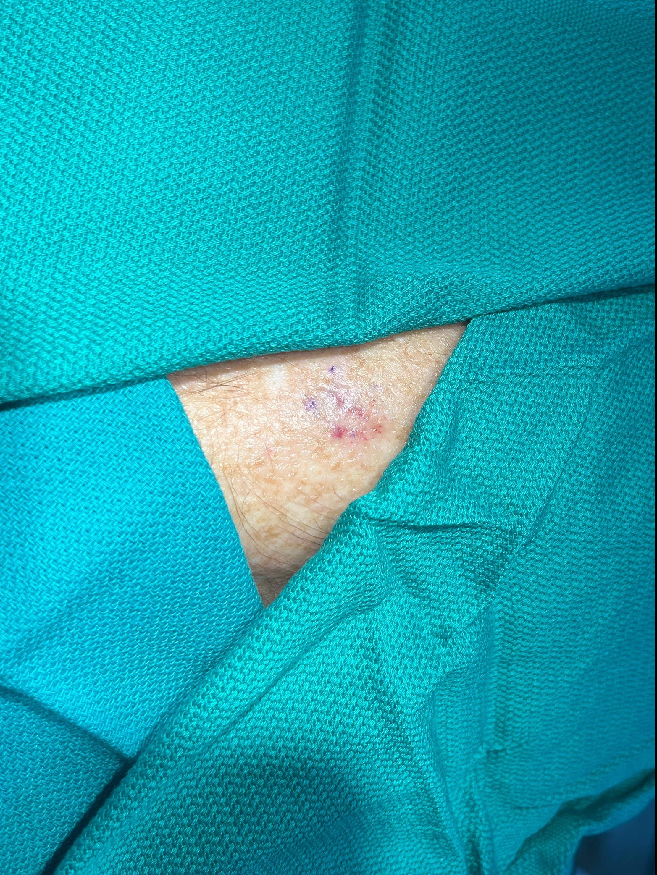 Cyst Removal Before and After Case- 72 Before