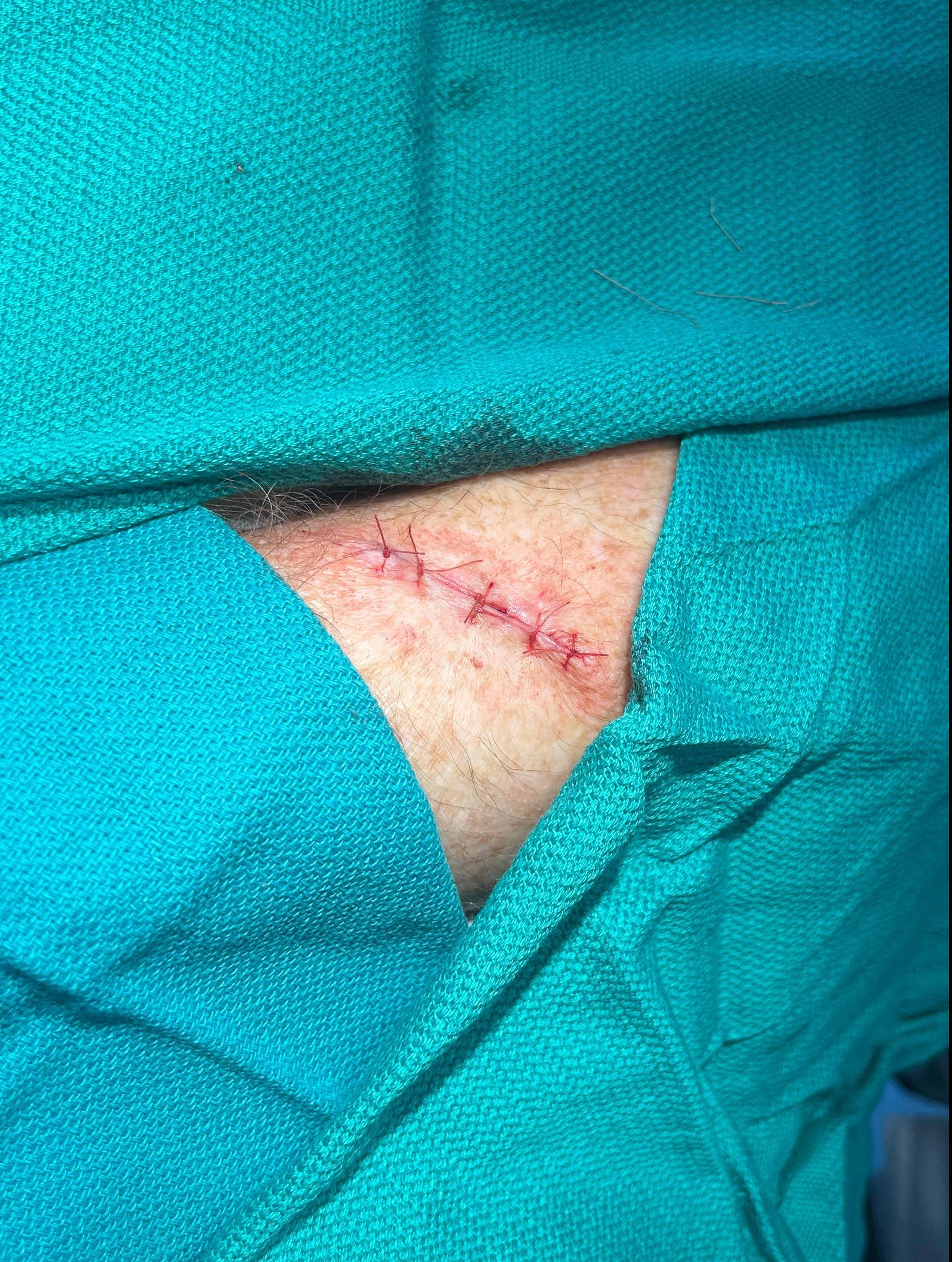 Cyst Removal Before and After Case- 72 After