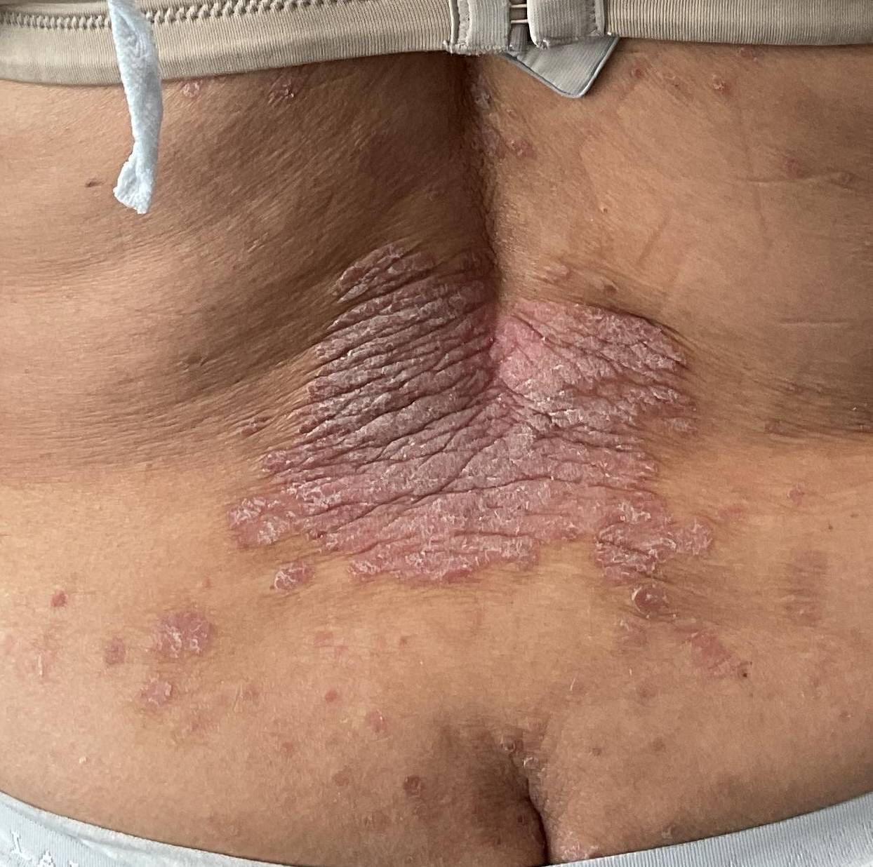 Psoriasis Before and After Case- 64 Before