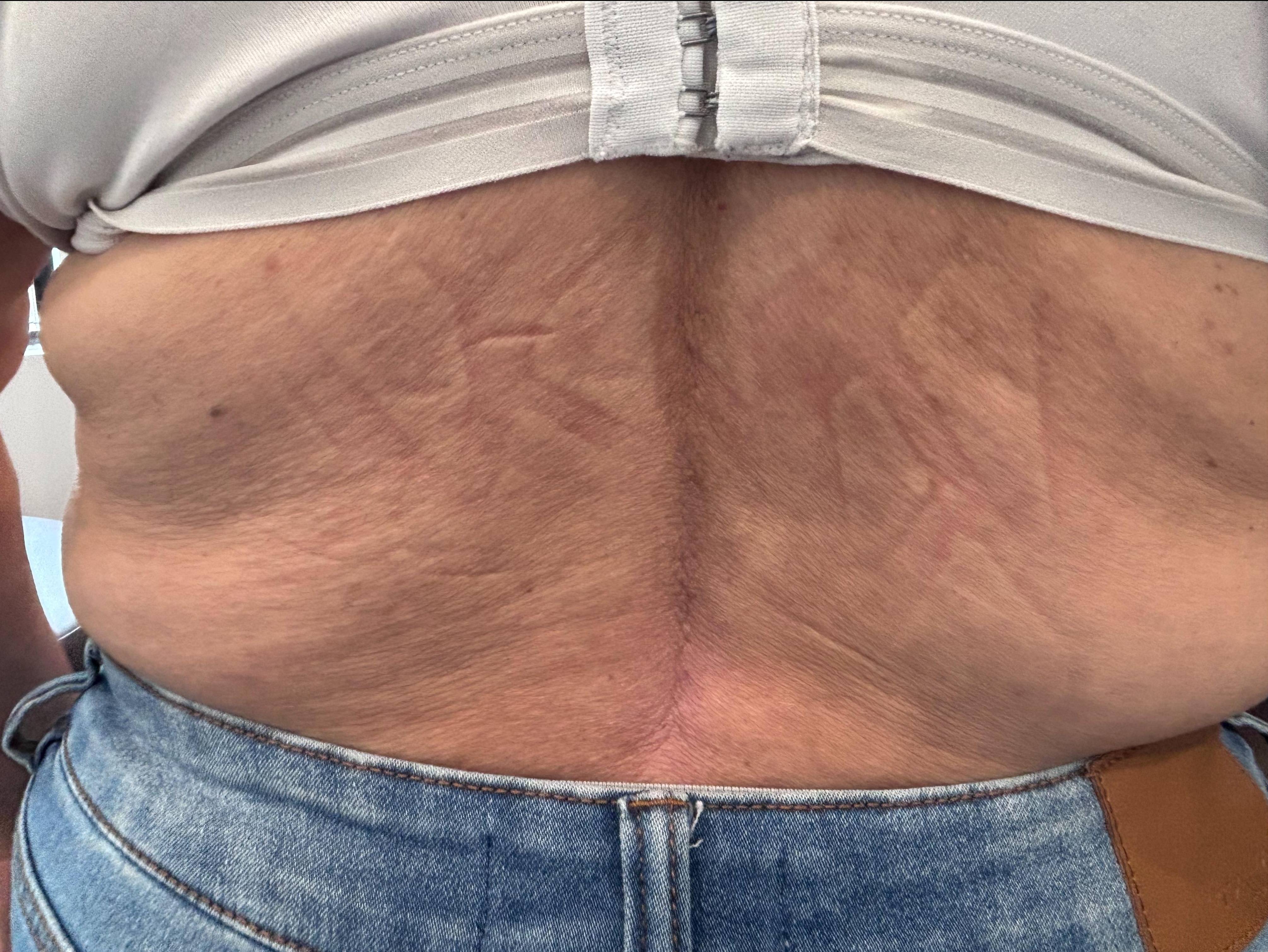 Psoriasis Before and After Case- 64 After