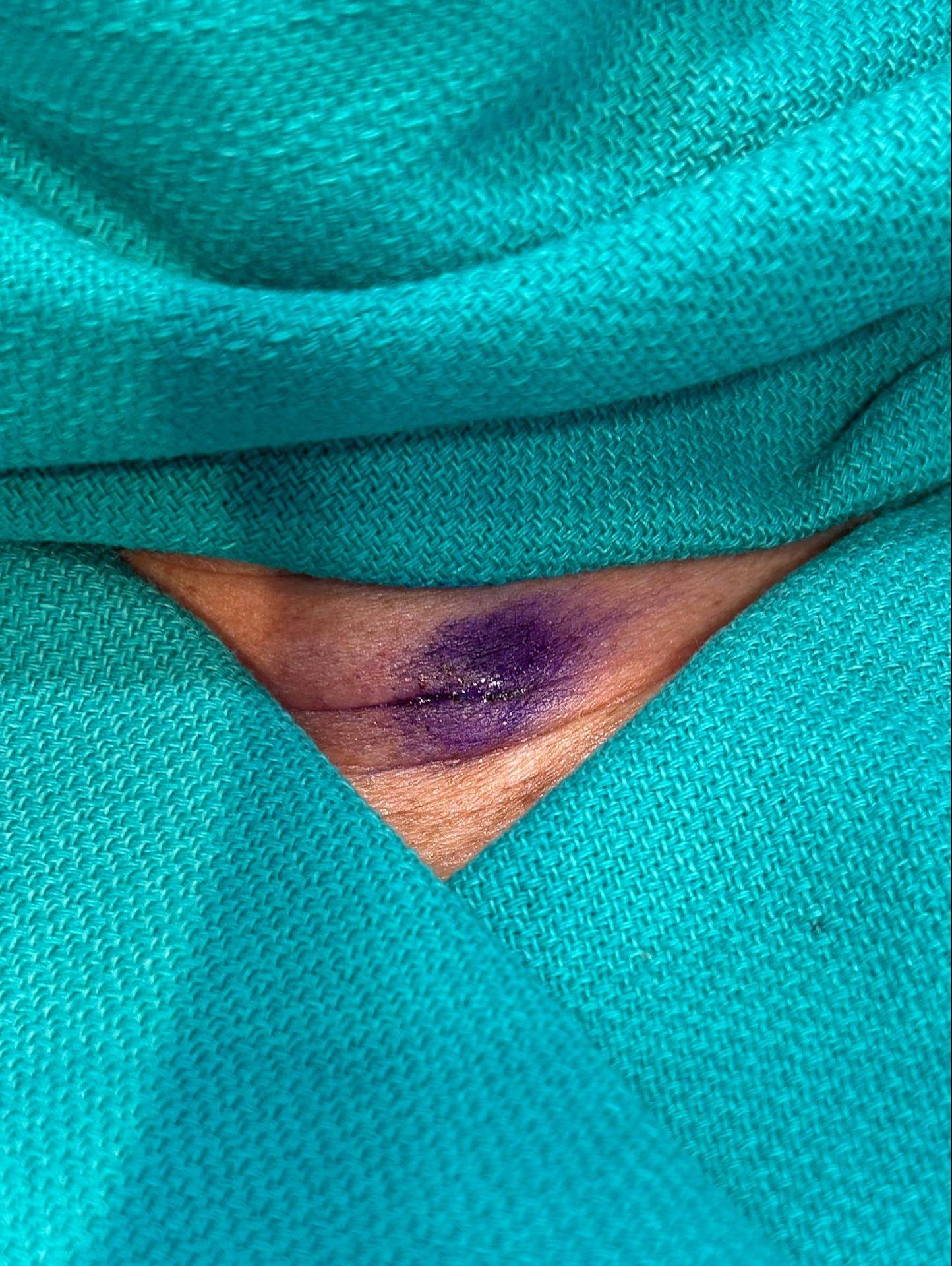 Cyst Removal Before and After Case- 73 Before