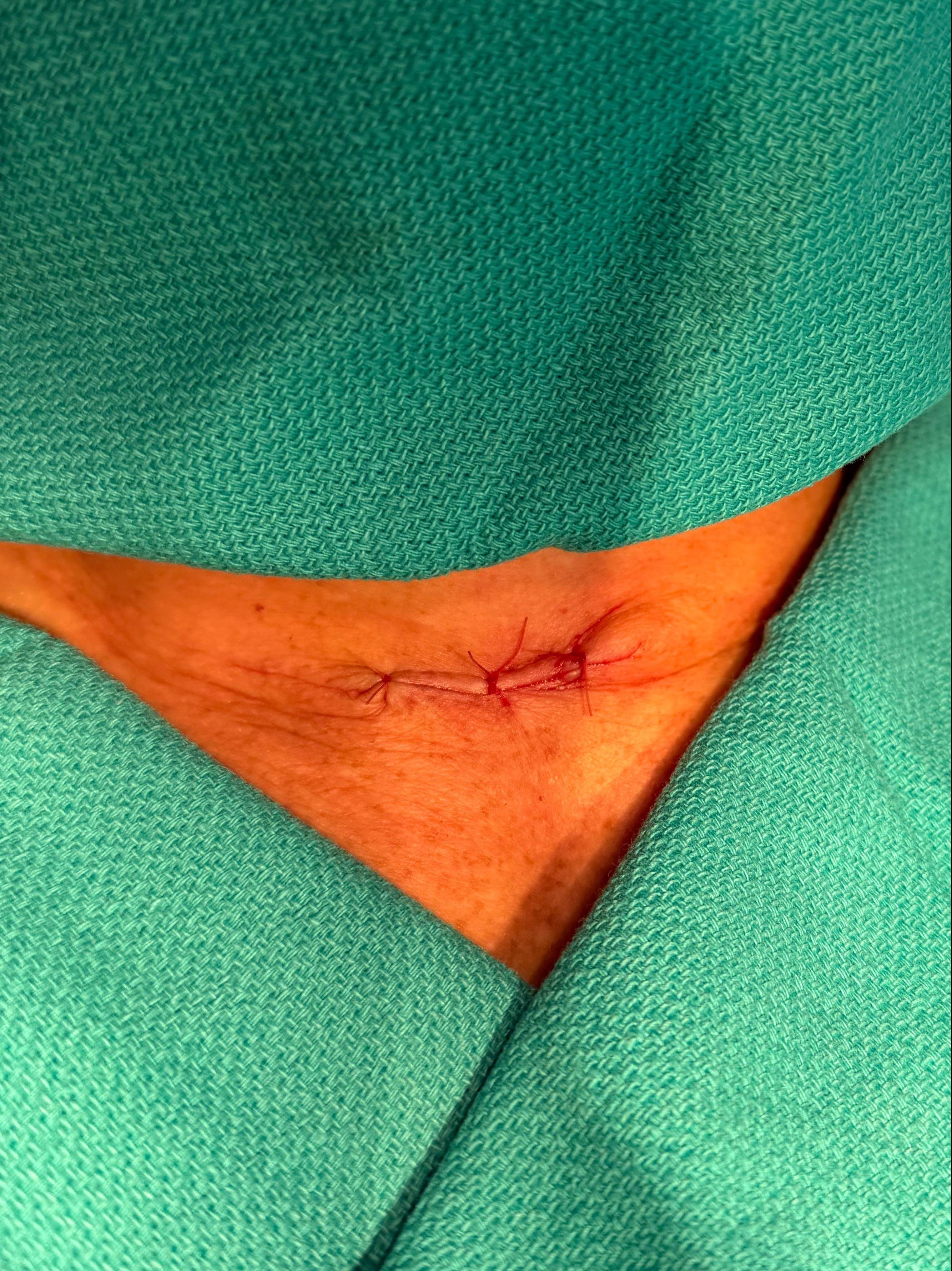 Cyst Removal Before and After Case- 73 After