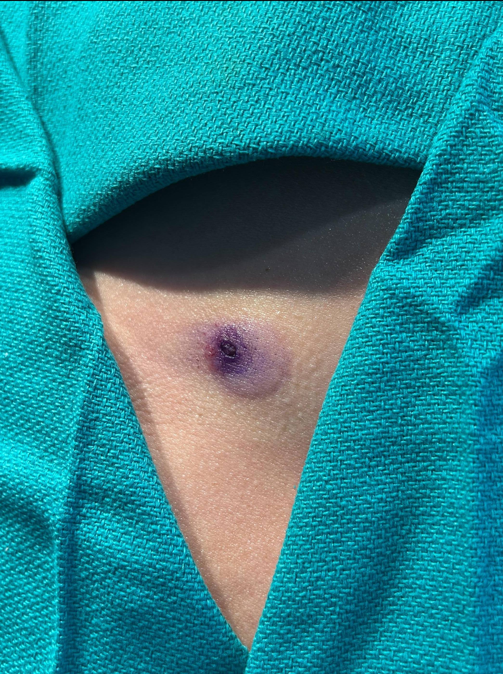 Cyst Removal Before and After Case- 74 Before