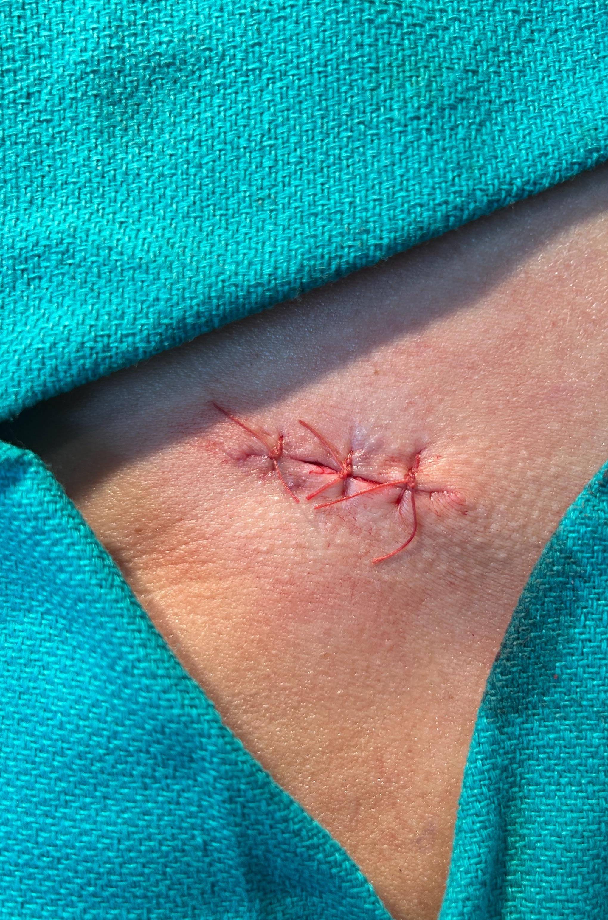 Cyst Removal Before and After Case- 74 After
