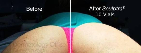 Sculptra (10 Vials) Before and After Case 1 