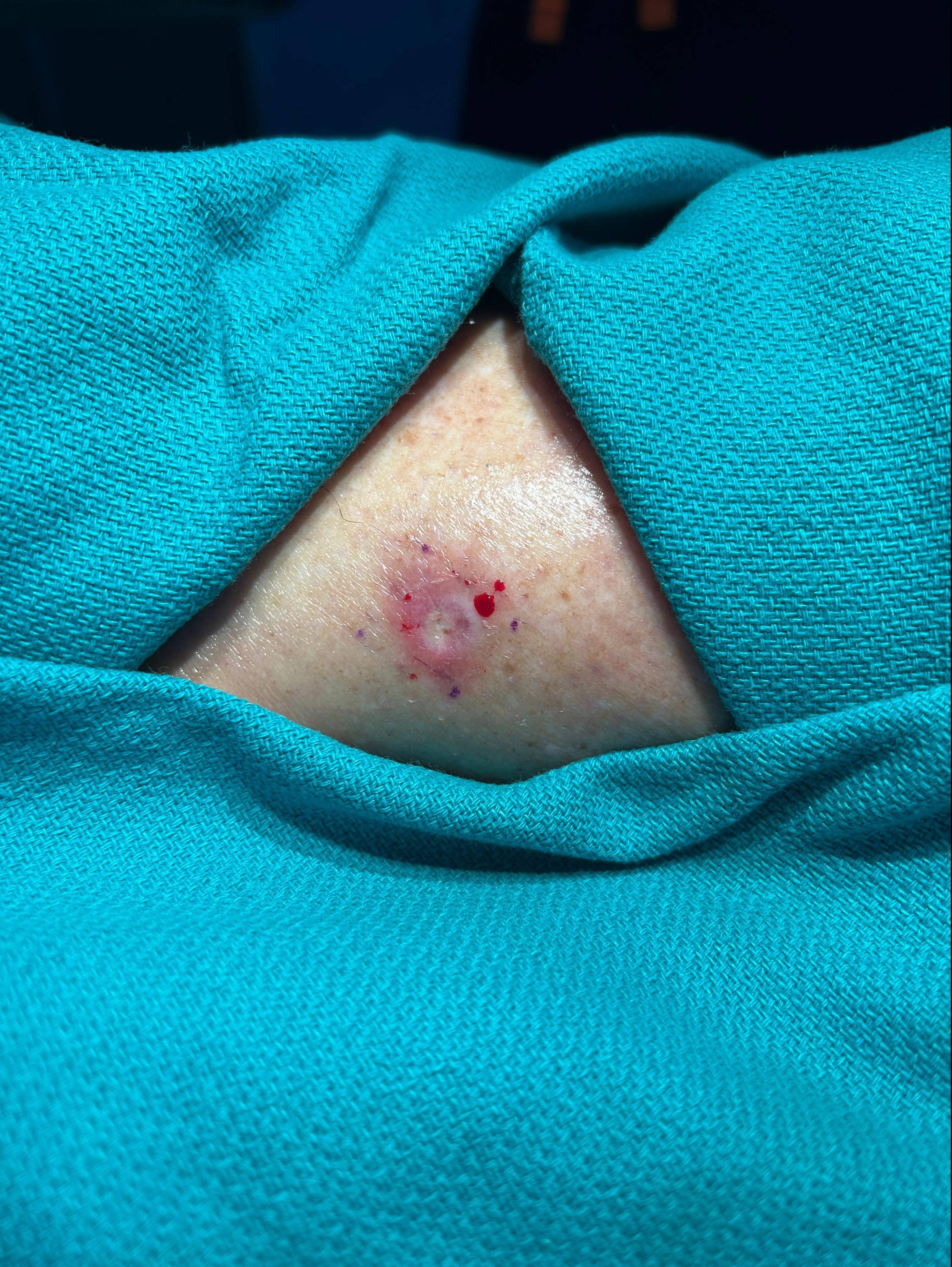 Cyst Removal Before and After Case- 75 Before
