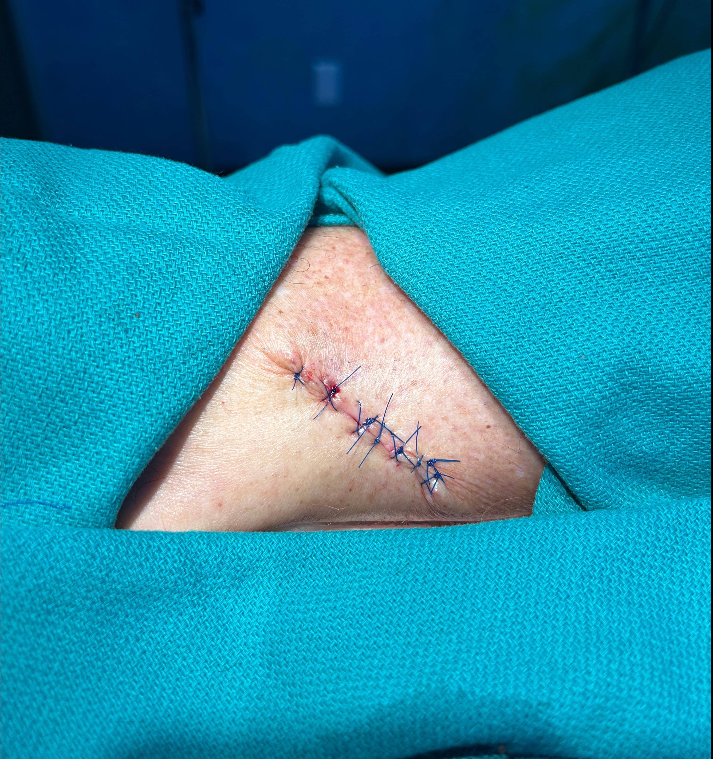 Cyst Removal Before and After Case- 75 After