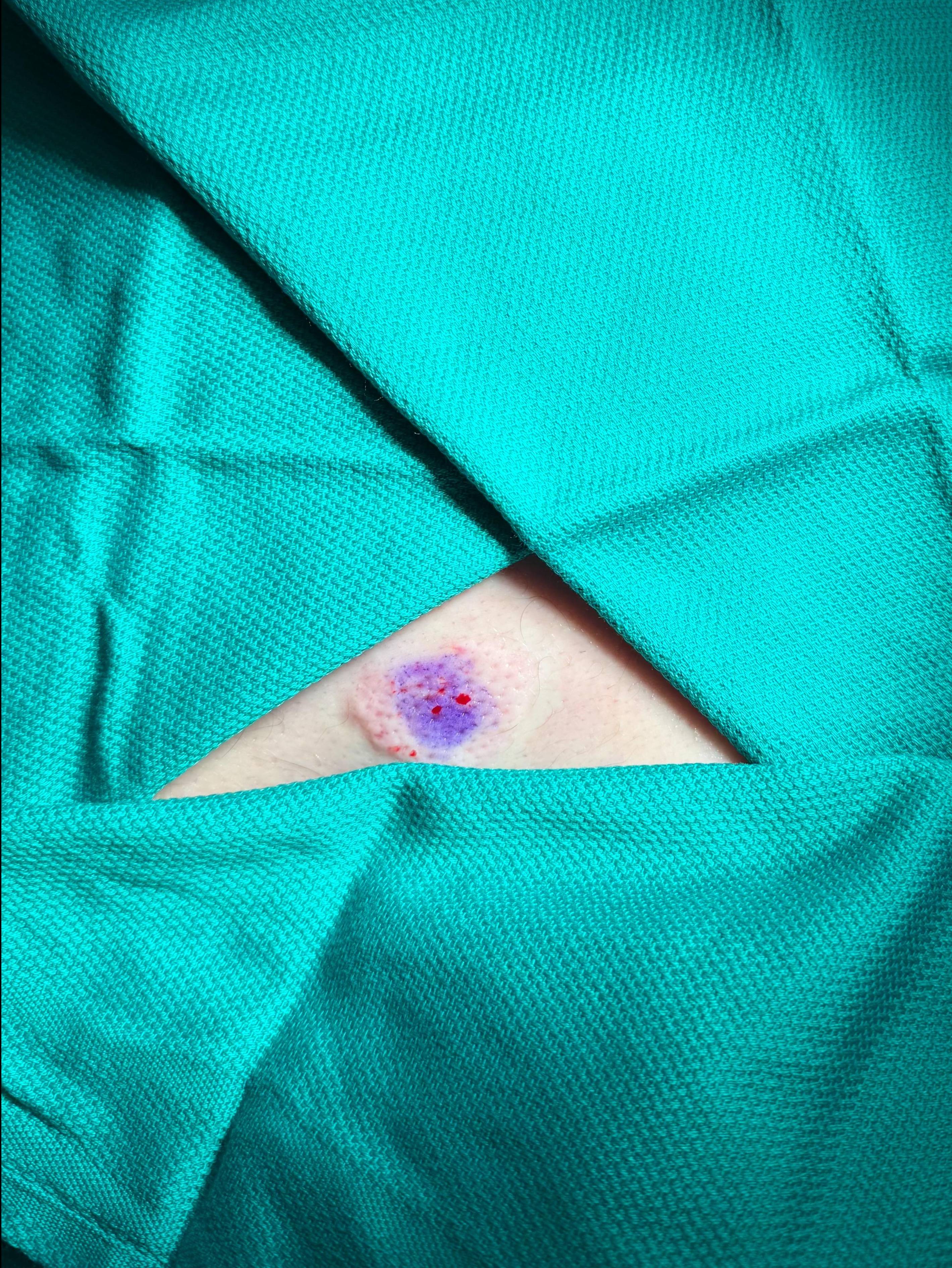 Cyst Removal Before and After Case- 76 Before