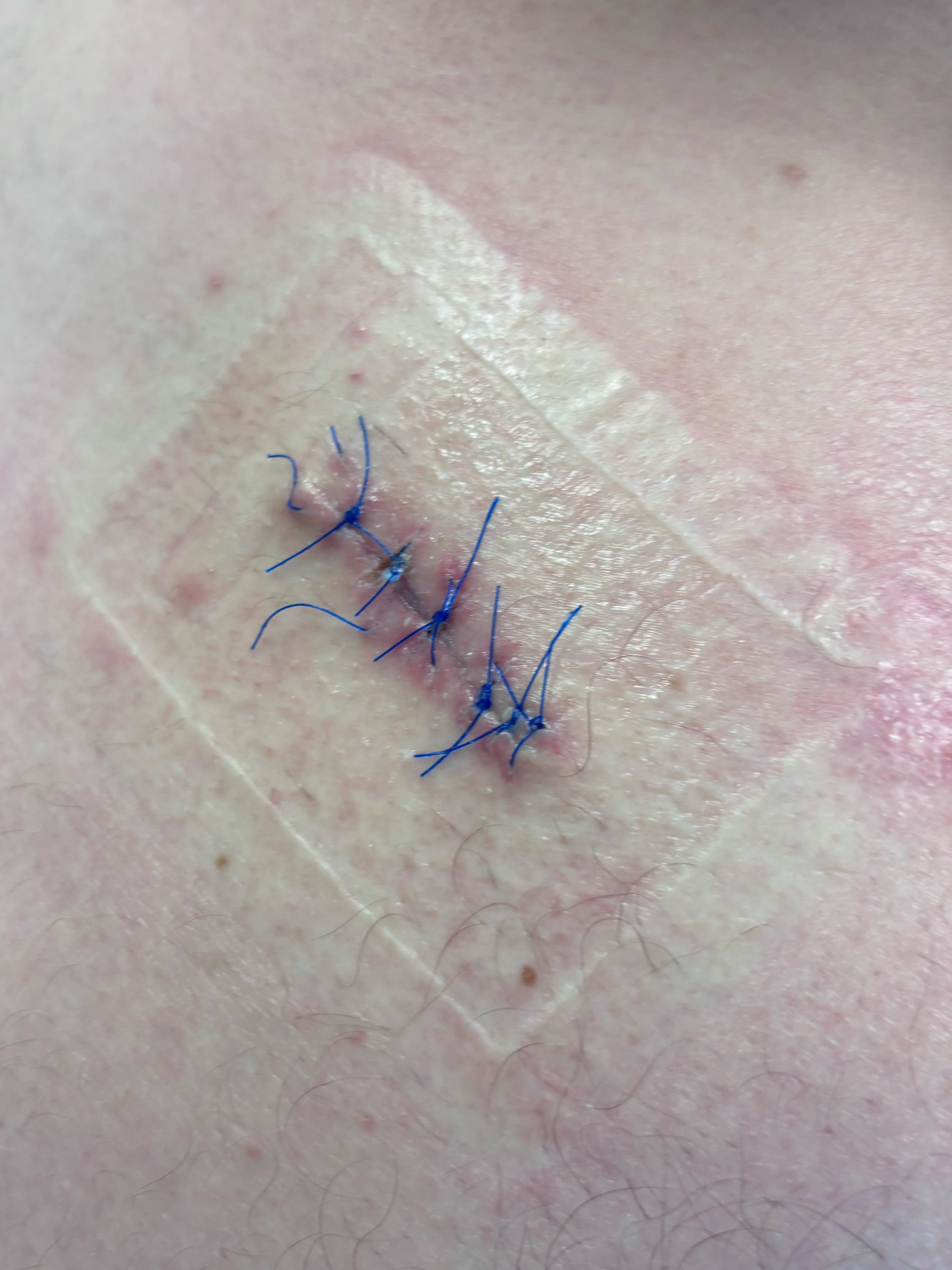 Cyst Removal Before and After Case- 76 After