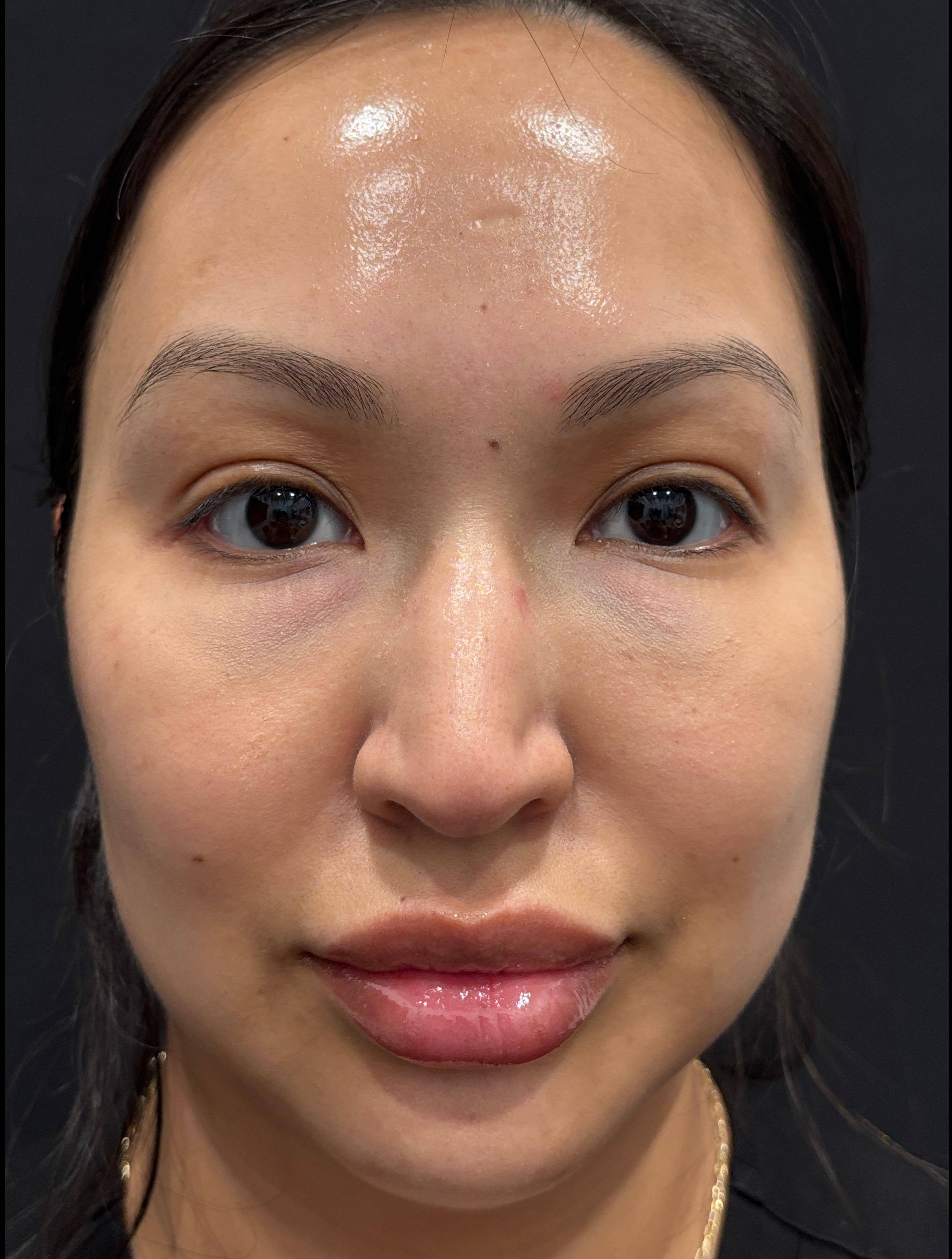 Dysport Before and After Case- 13 After
