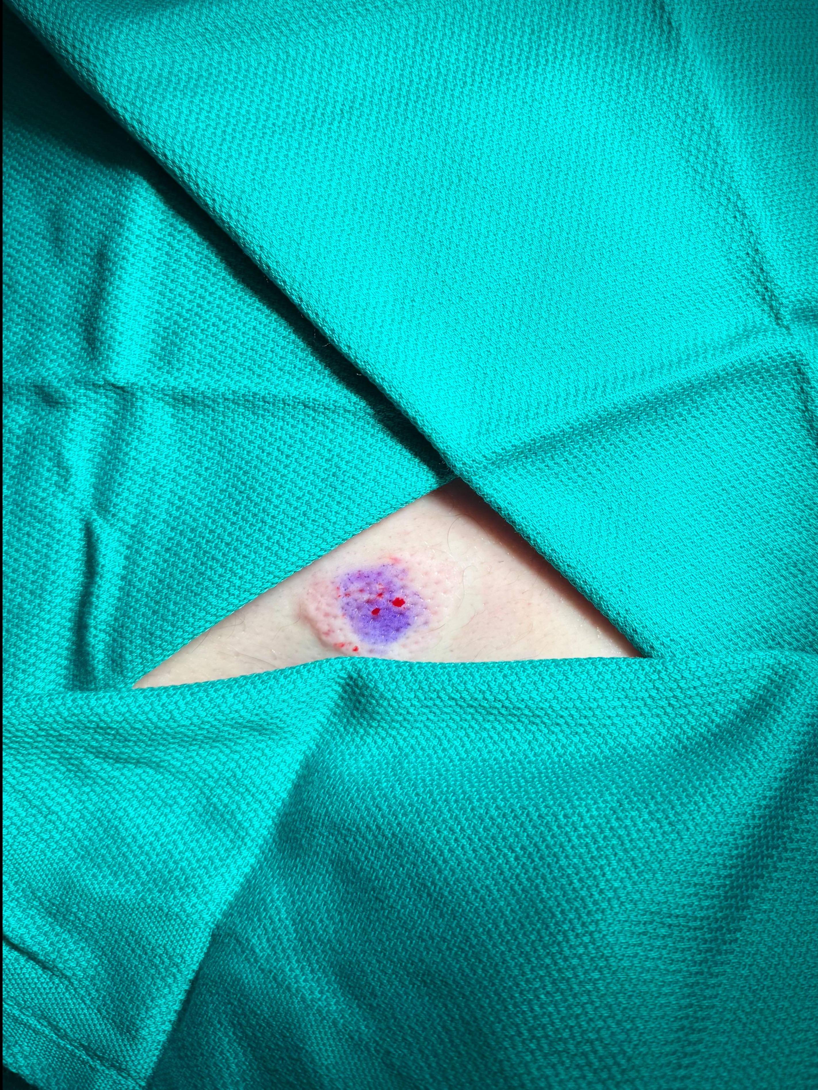 Lipoma Before and After Case- 7 Before