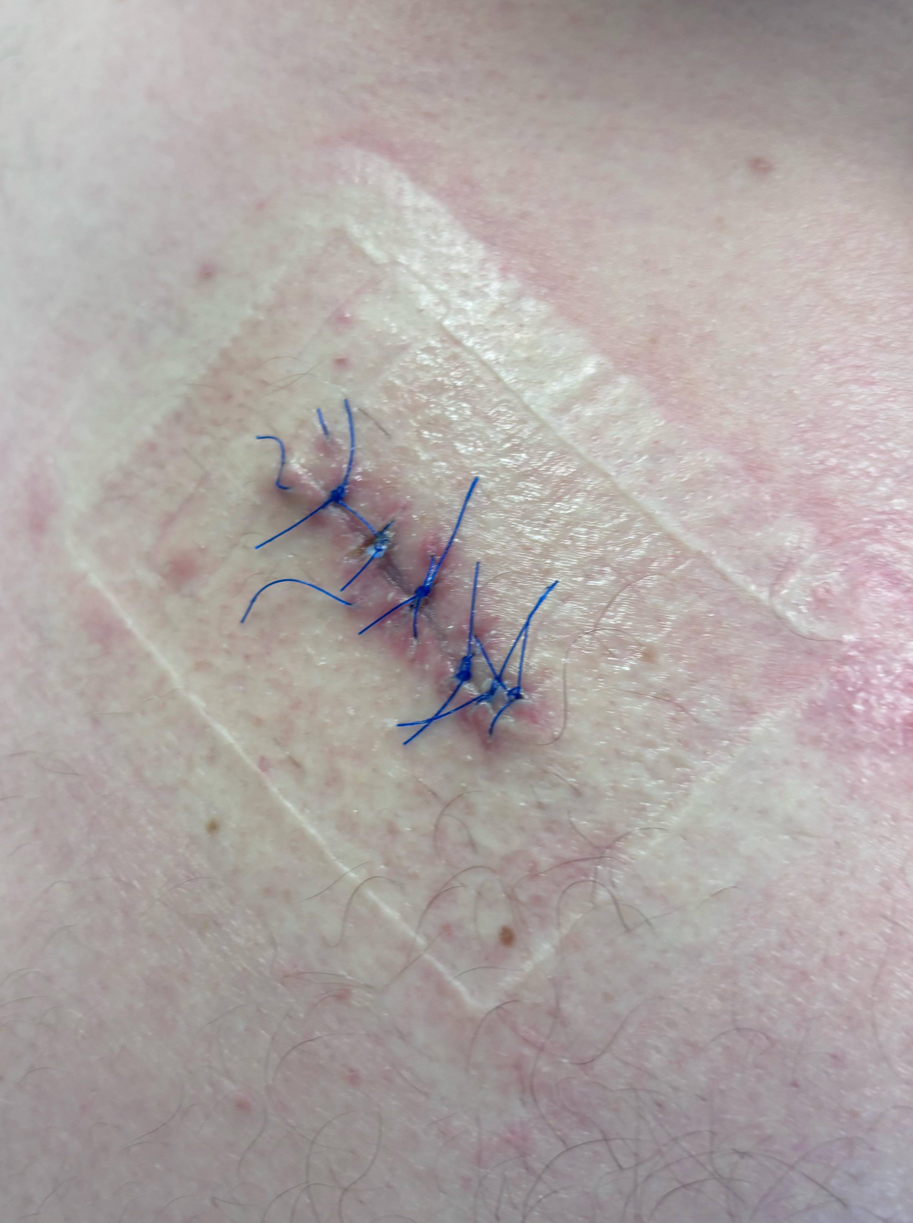 Lipoma Before and After Case- 7 After
