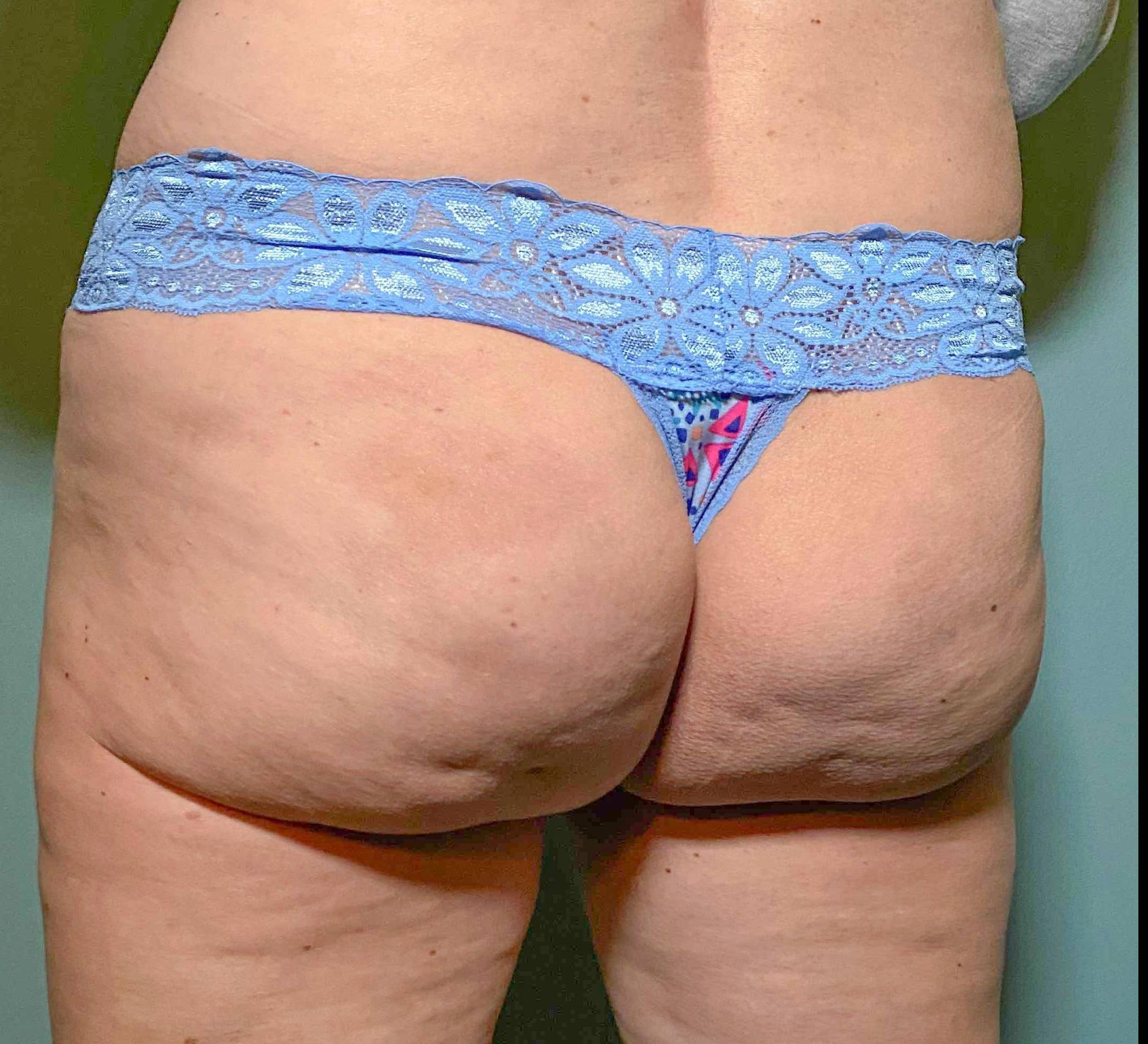 Radiesse Butt Augmentation Case 3 Before