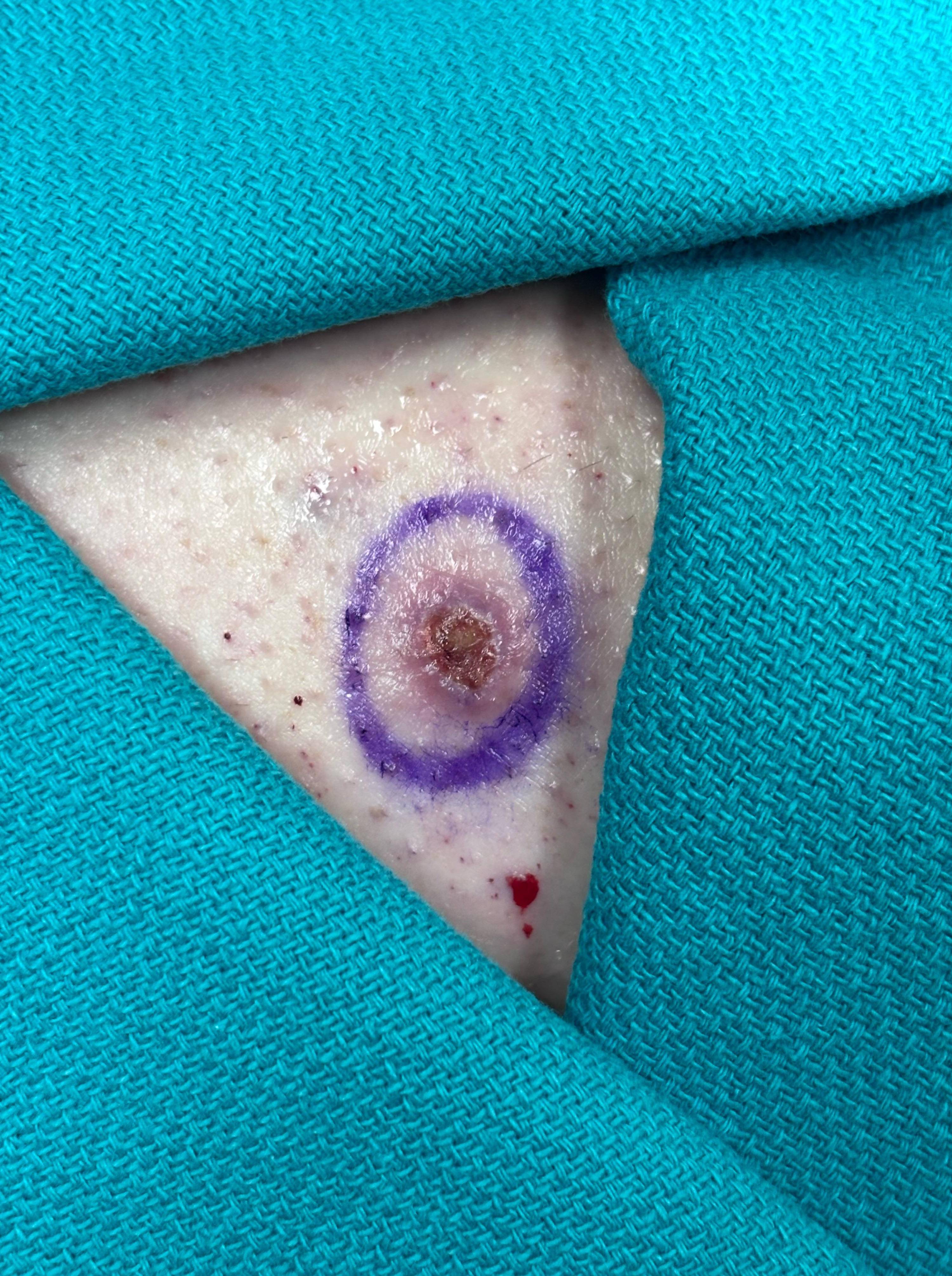 Cyst Removal Before and After Case- 77 Before