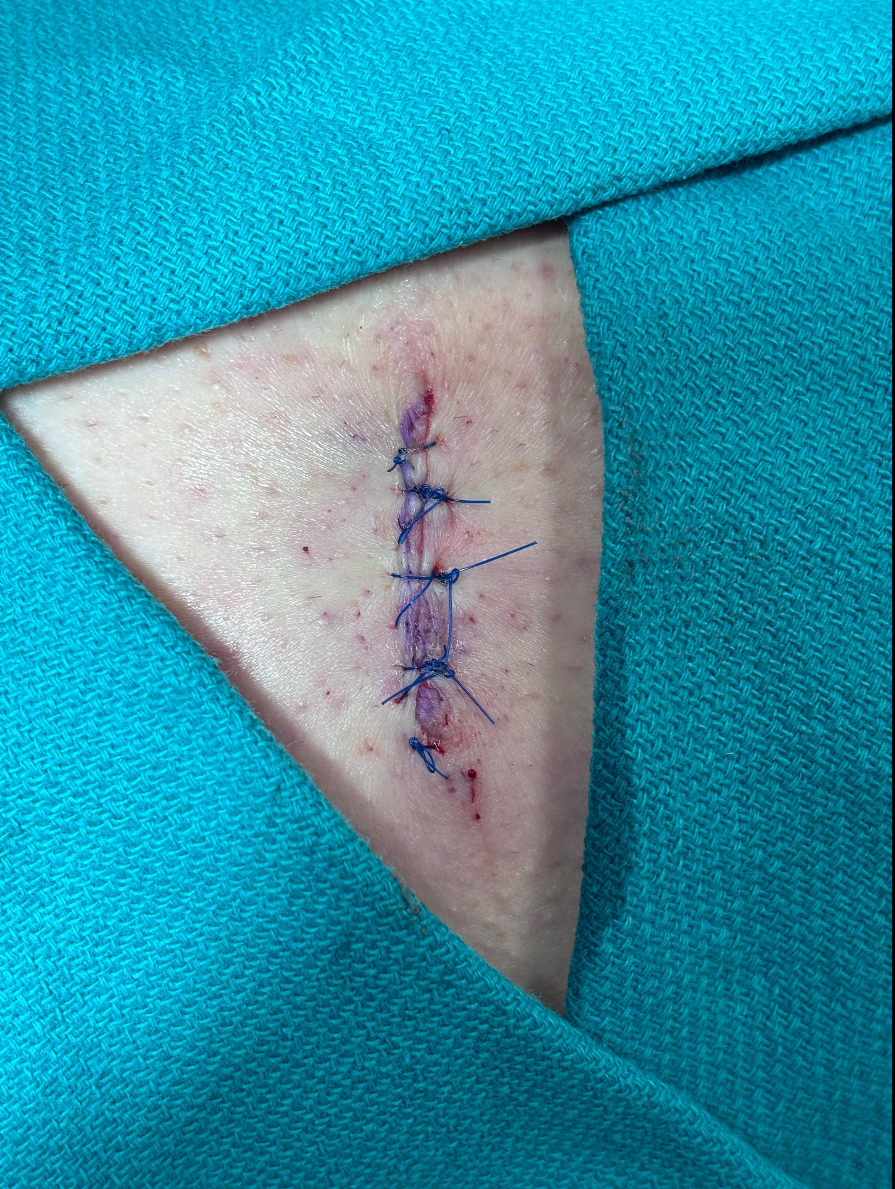 Cyst Removal Before and After Case- 77 After