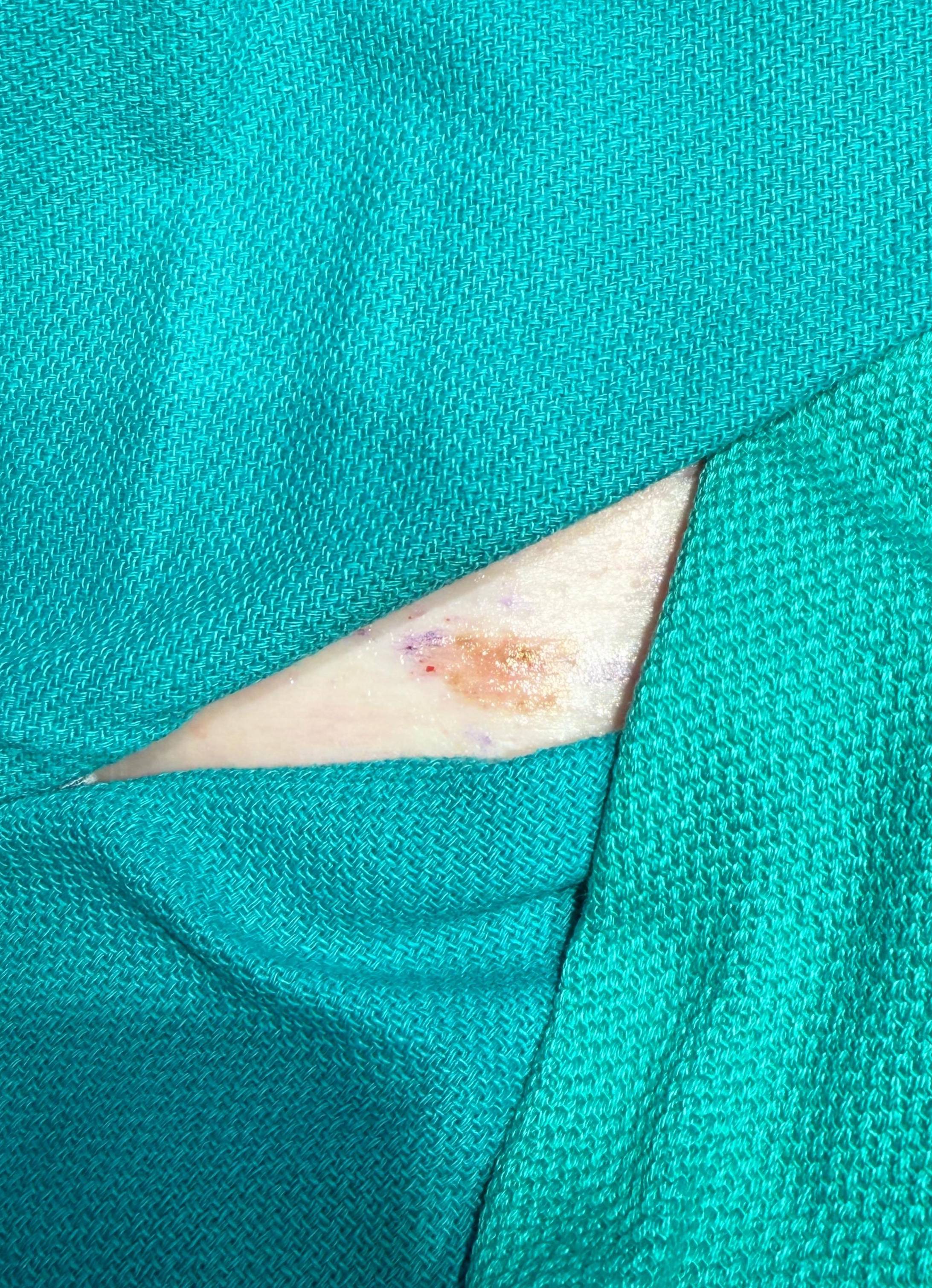 Cyst Removal Before and After Case- 78 Before